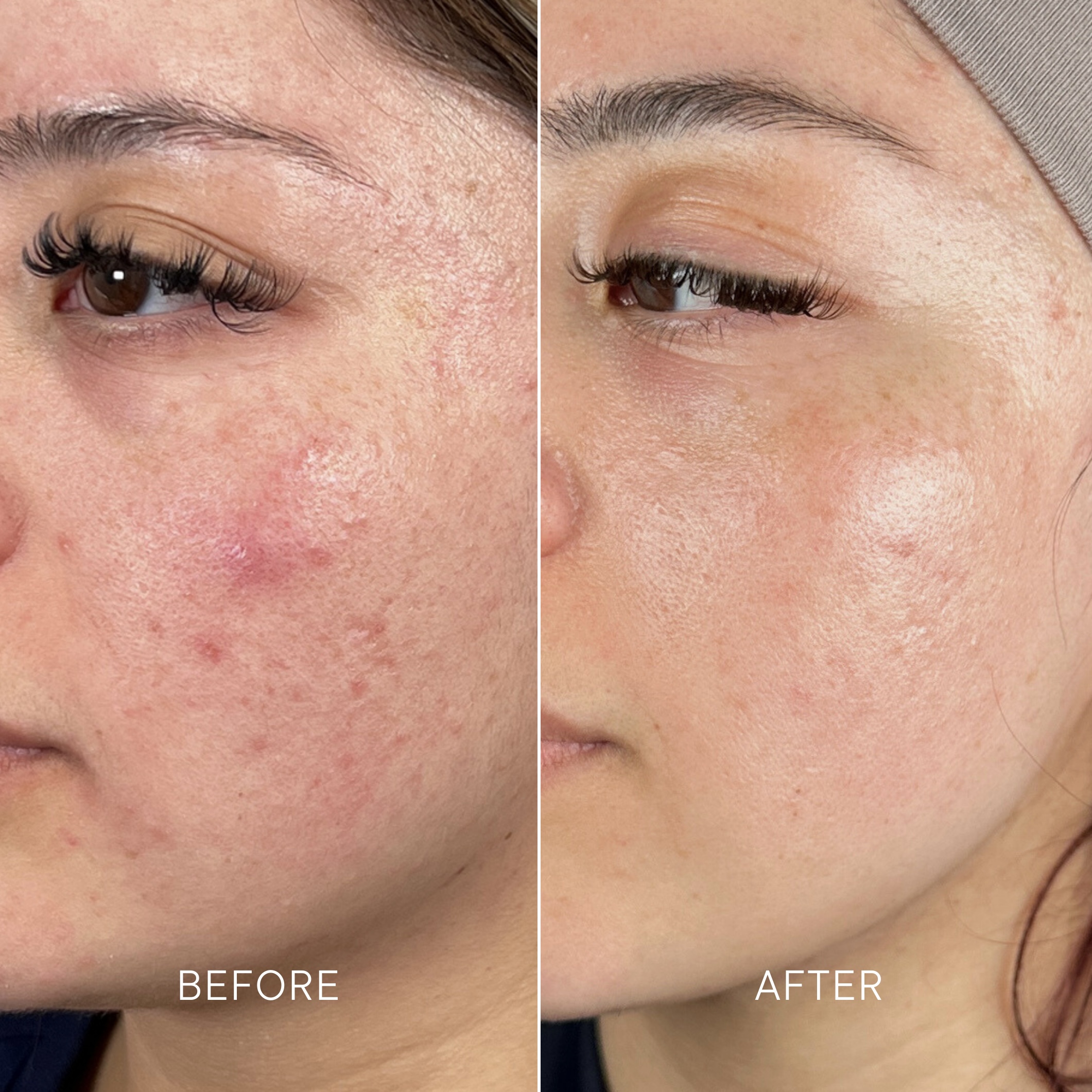 Artisa skincare before and after · before and after composite