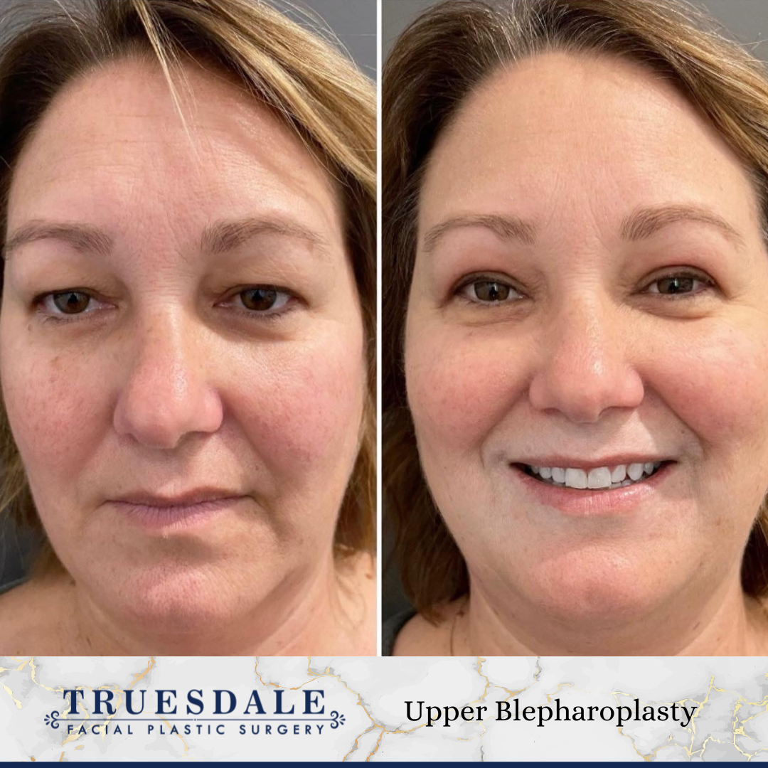 Before and after — upper blepharoplasty · before and after composite