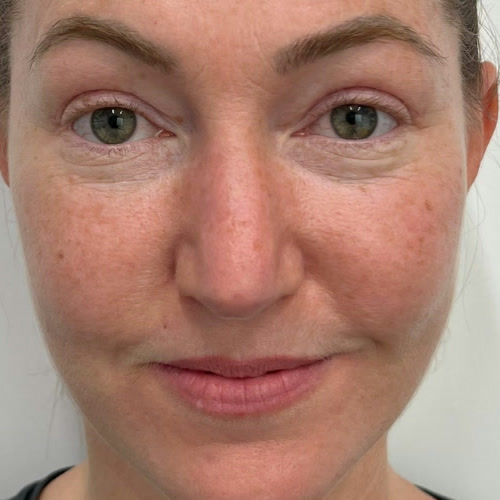 Featured patient before and after - Blepharoplasty · before and after composite