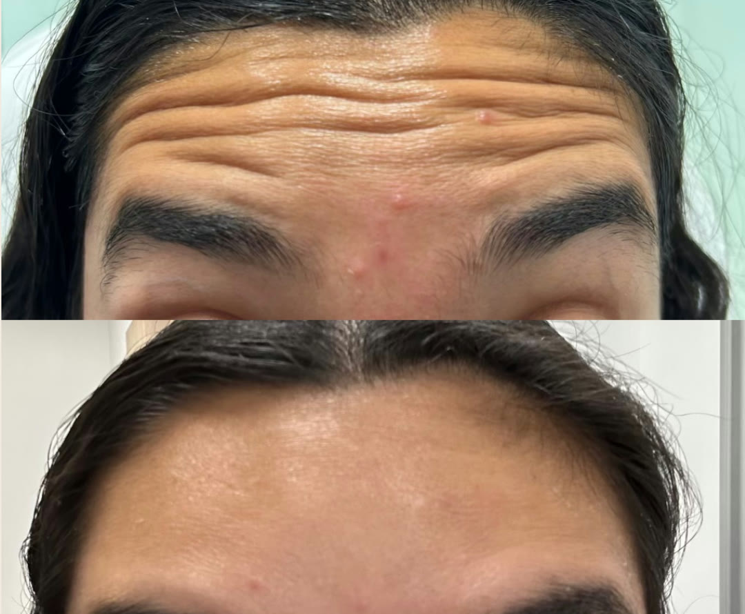 Before and after &mdash; Daxxify &mdash; Forehead Lines · before and after composite