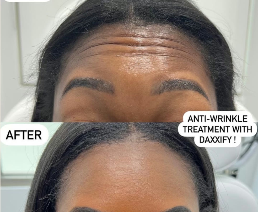 Daxxify before and after &mdash; smoothed forehead lines · before and after composite