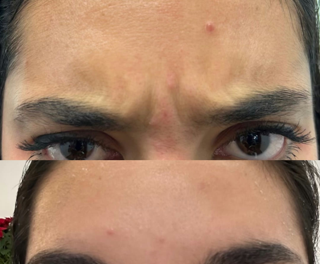 Before and after &mdash; Daxxify &mdash; Glabellar (&ldquo;11s&rdquo;) · before and after composite