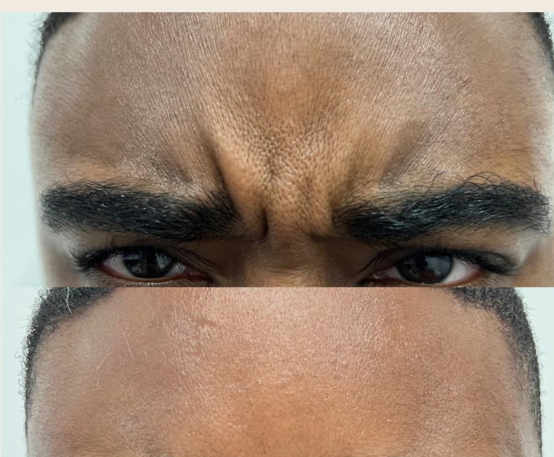 Before and after &mdash; Daxxify &mdash; Glabellar (&ldquo;11s&rdquo;) · before and after composite