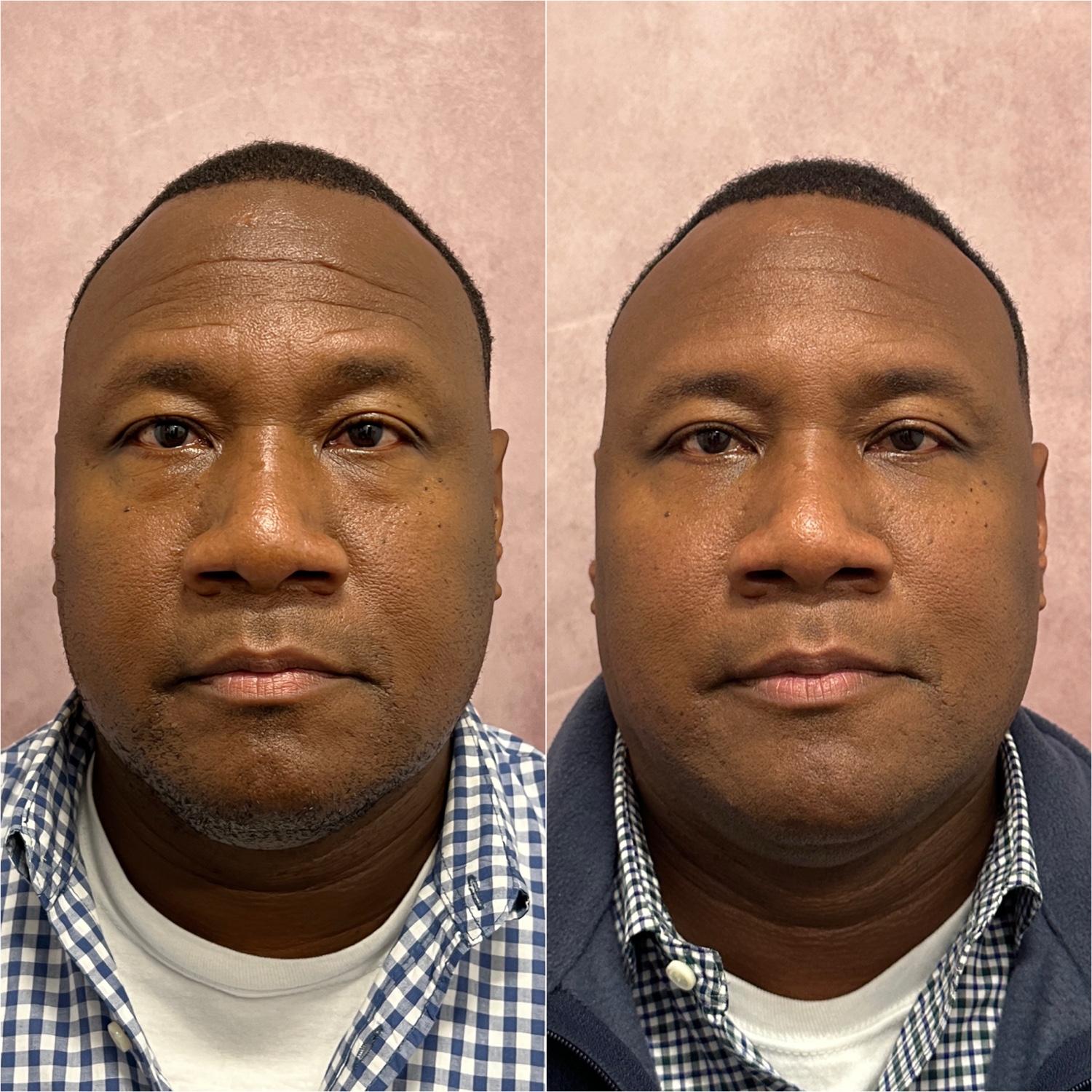 Male brow lift and lower blepharoplasty before and after · frontal view