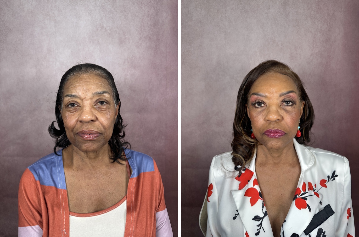 Before and after &mdash; brow lift with facelift, neck lift, and lower blepharoplasty, frontal view