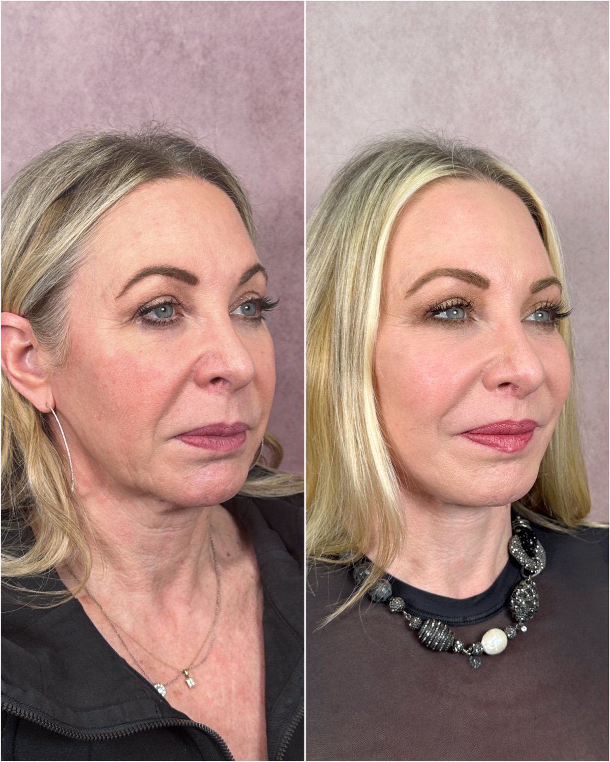Before and after &mdash; brow lift as part of The Masterpiece, profile view