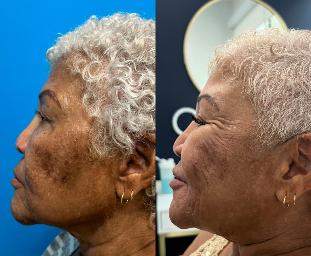 Chemical peel before and after &mdash; melasma and hyperpigmentation correction on melanin-rich skin, profile view