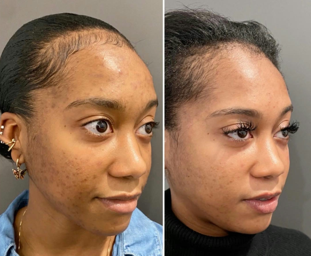 Chemical peel before and after &mdash; tone and texture correction on melanin-rich skin, oblique view