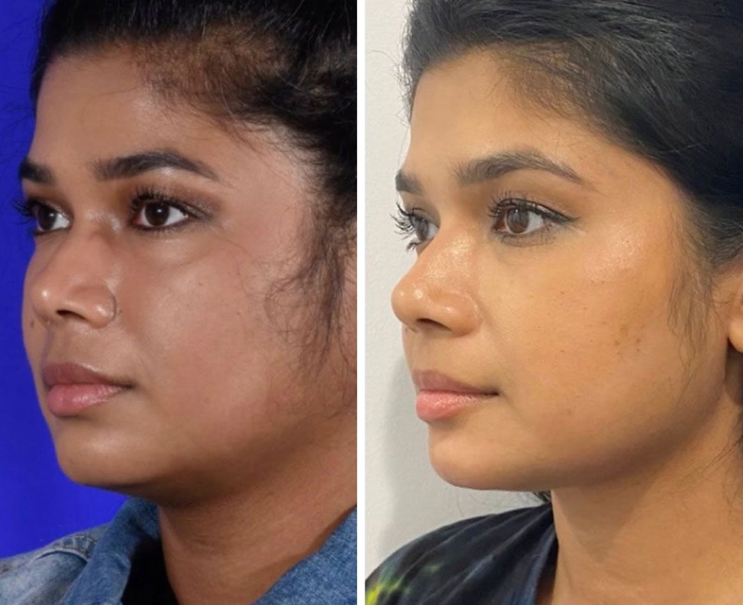 Chin implant + buccal fat excision before and after, oblique view