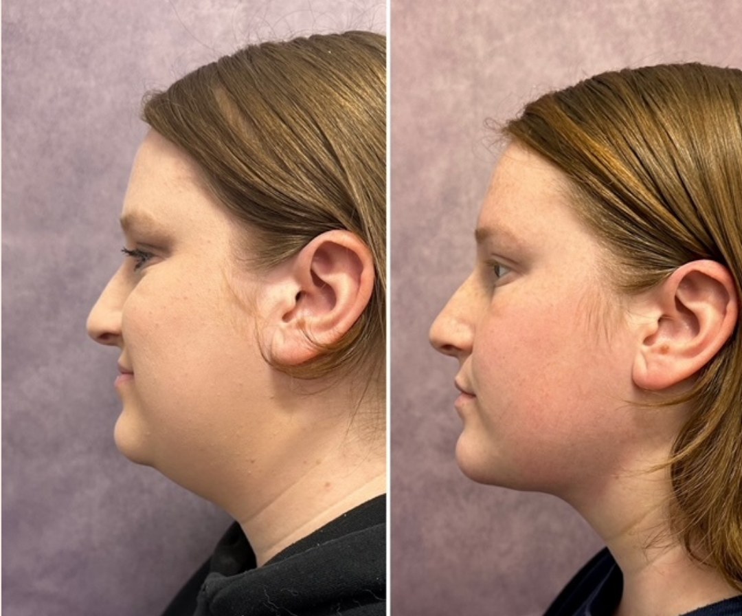 Before and after &mdash; neck liposuction · before and after composite