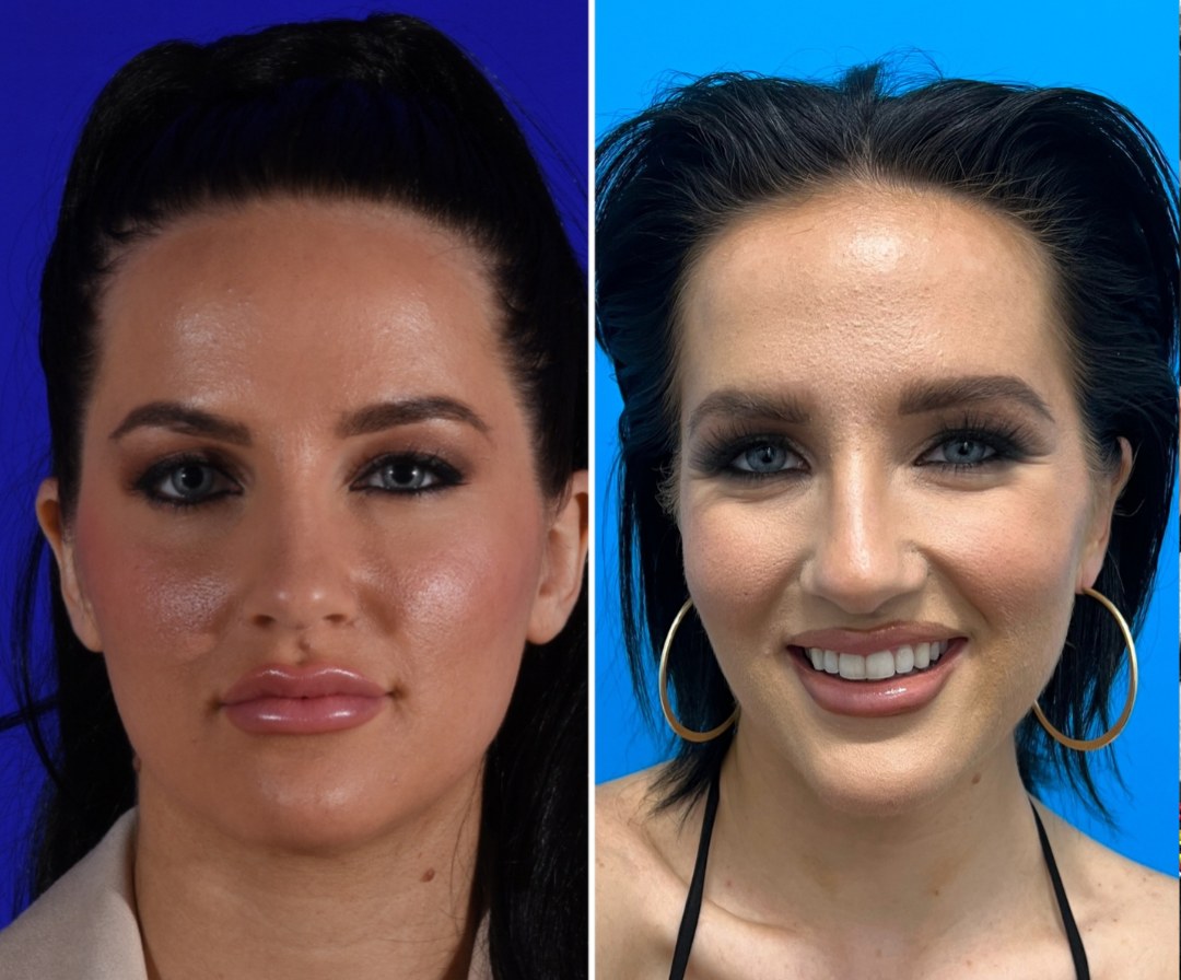 Before and after &mdash; buccal fat excision · before and after composite