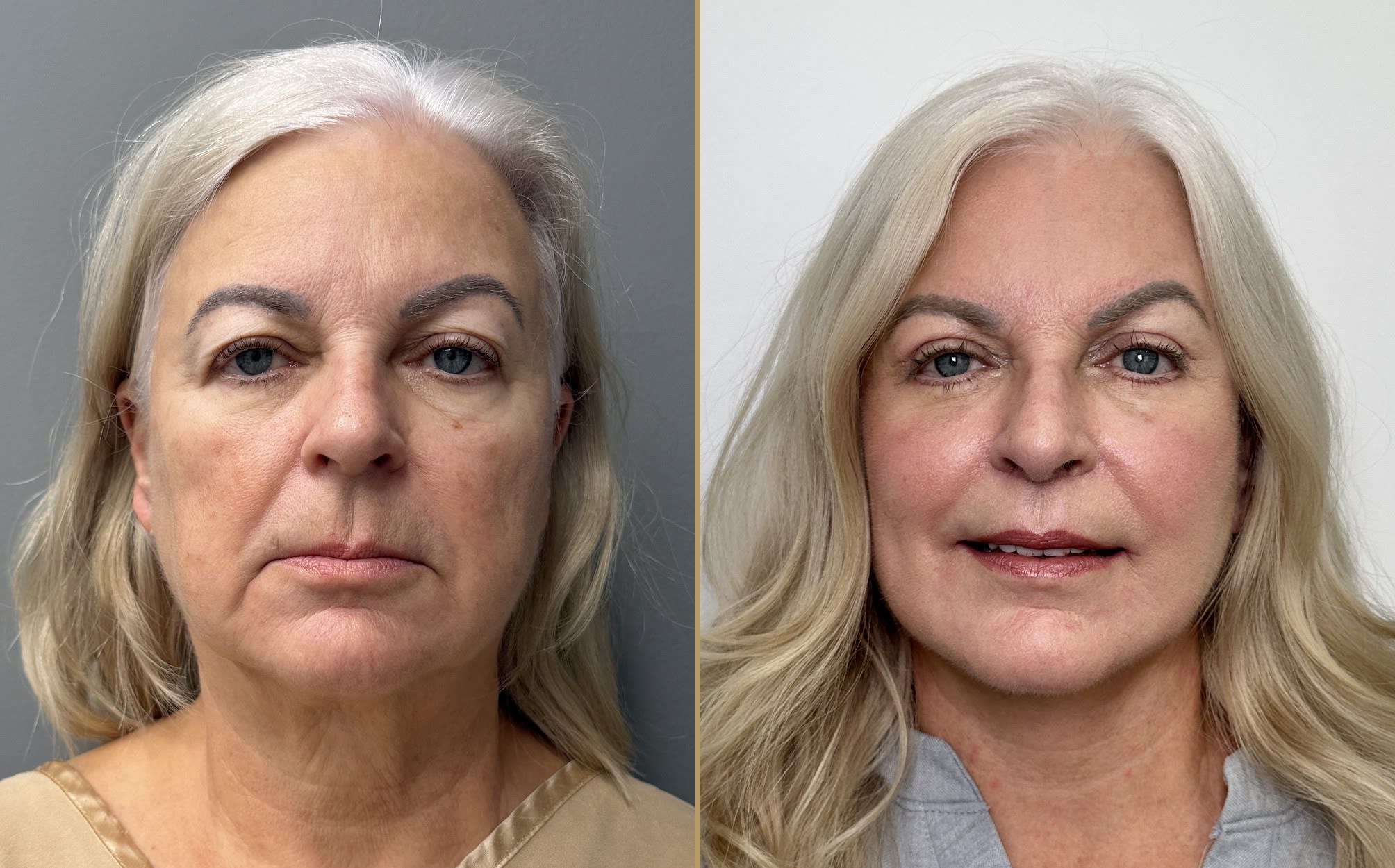 CO2 laser combined with surgical procedures before and after · before and after composite