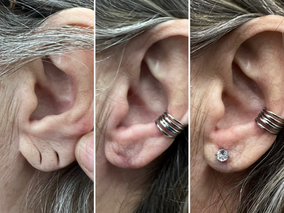 Earlobe repair before and after &mdash; featured patient · before and after composite