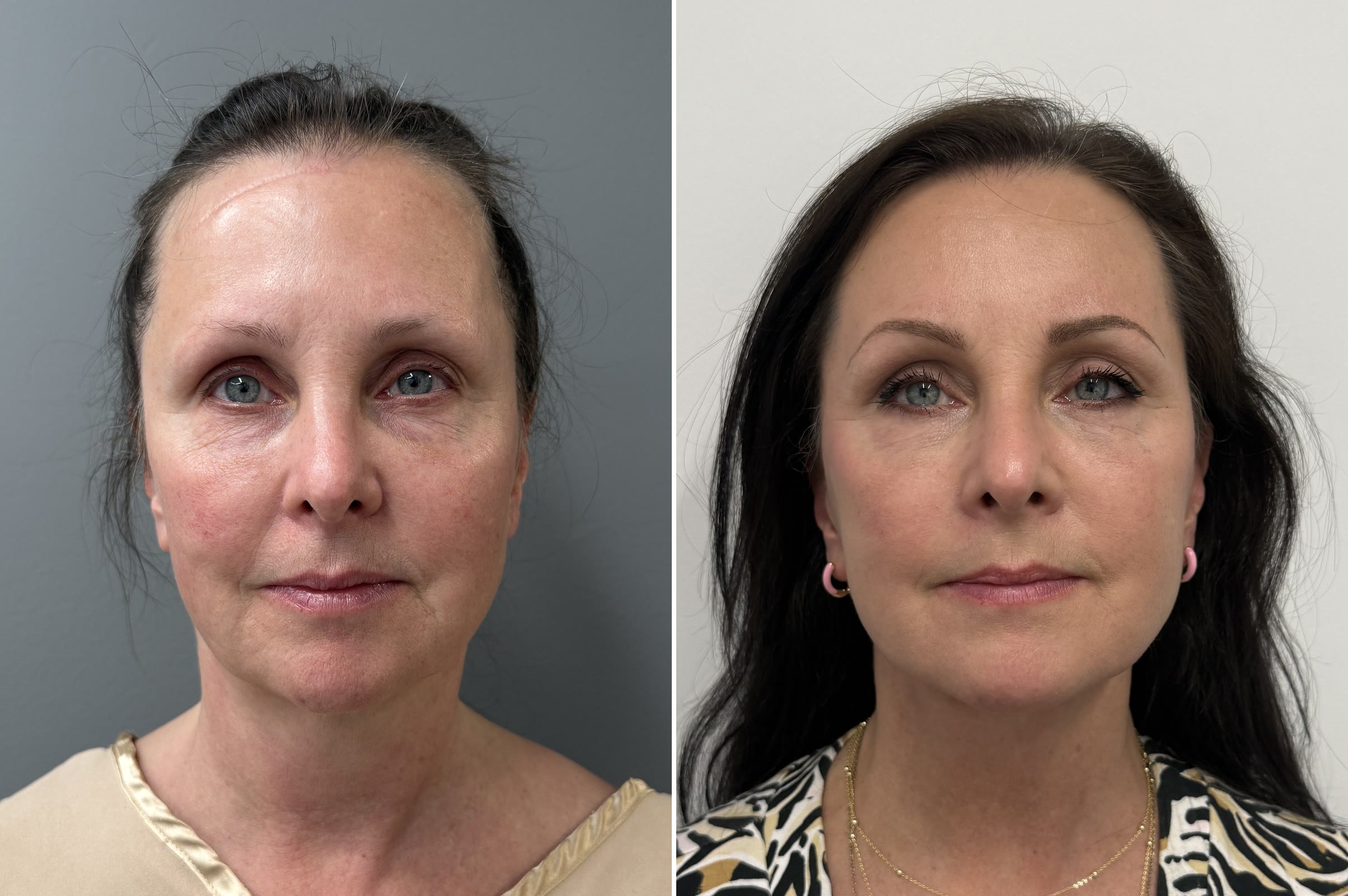 Face and Neck Lift + Blepharoplasty + CO2 Laser before and after · before and after composite