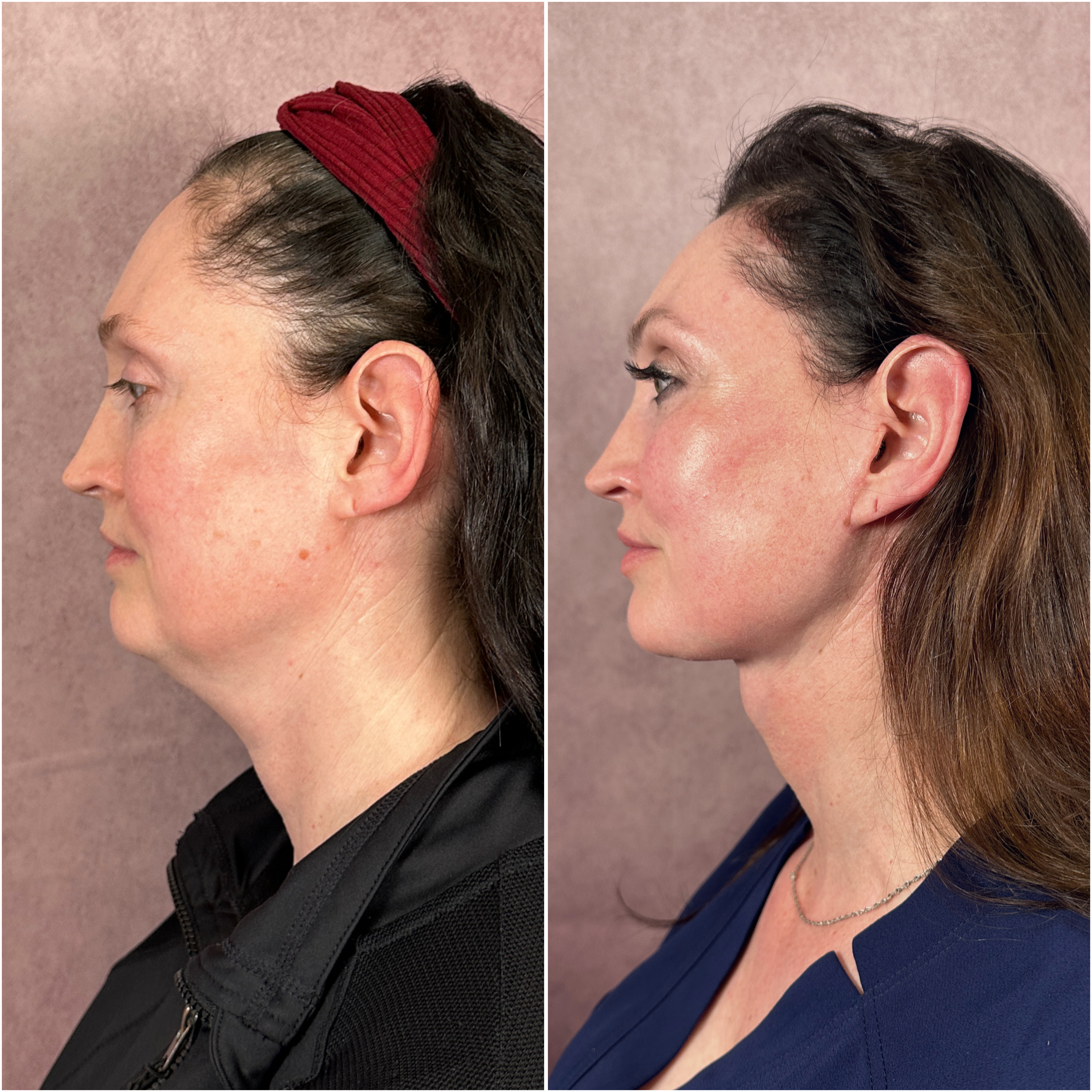 Before and after &mdash; The Masterpiece Surgery&trade;, profile view