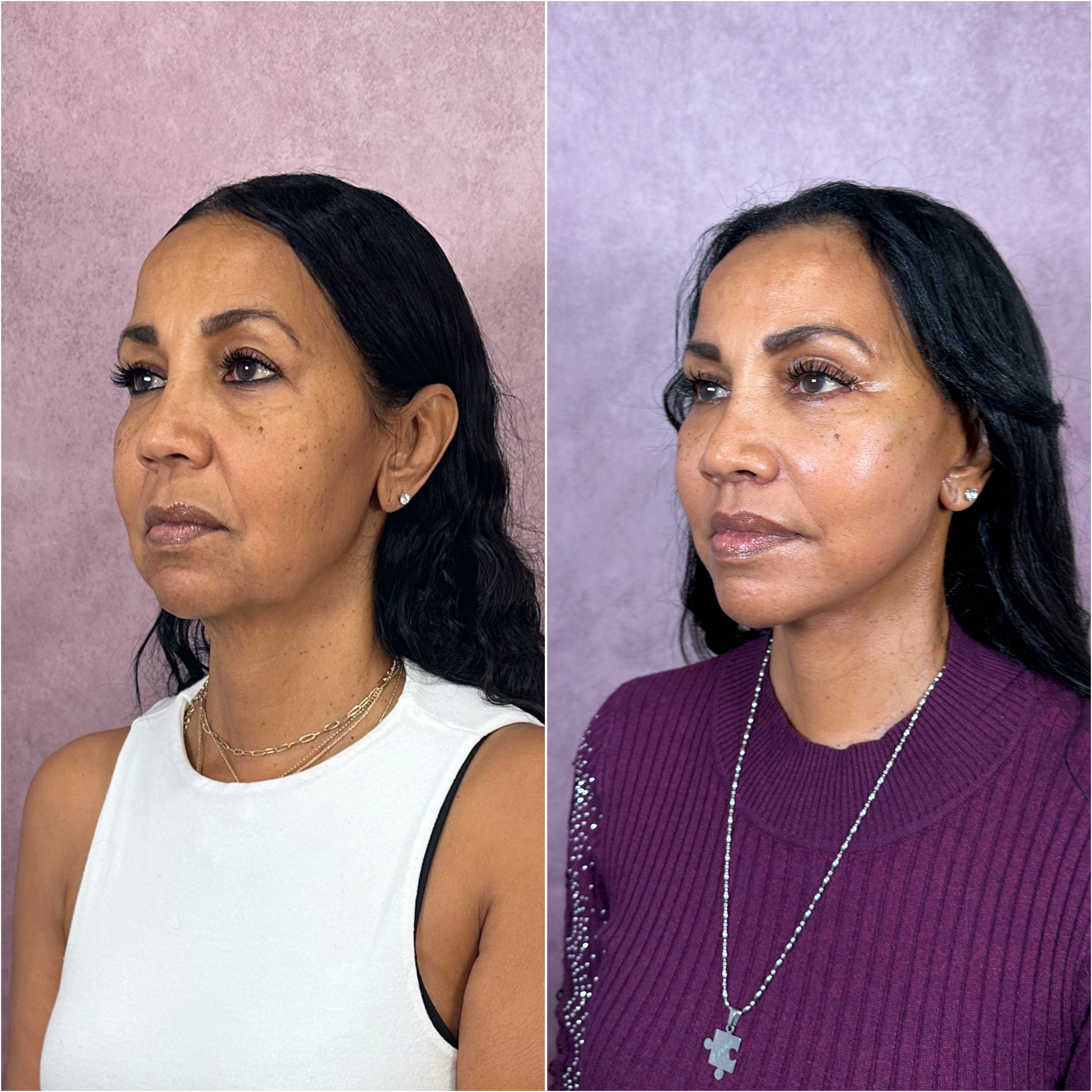 Before and after &mdash; The Masterpiece Surgery&trade;, oblique view