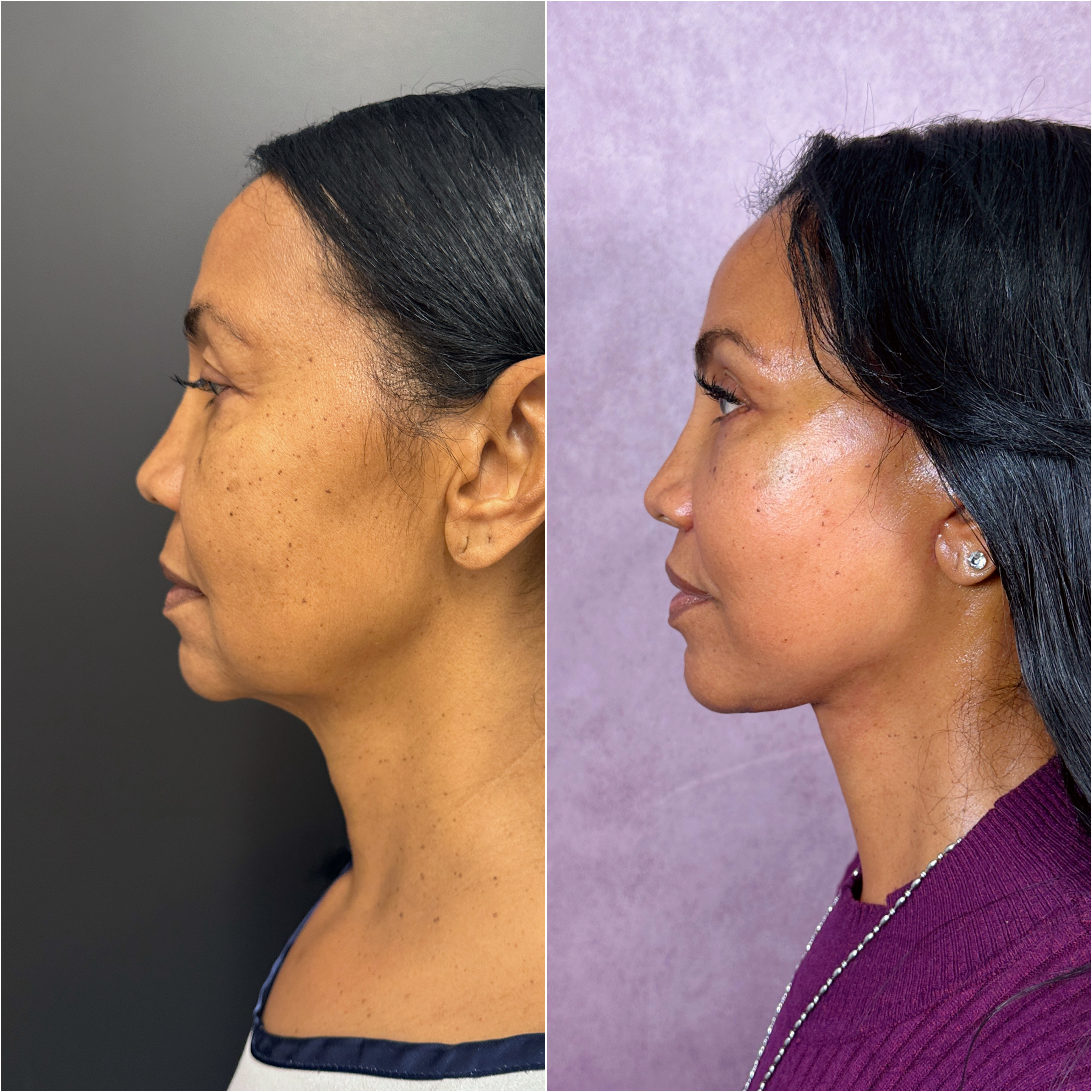 Before and after &mdash; The Masterpiece Surgery&trade;, profile view