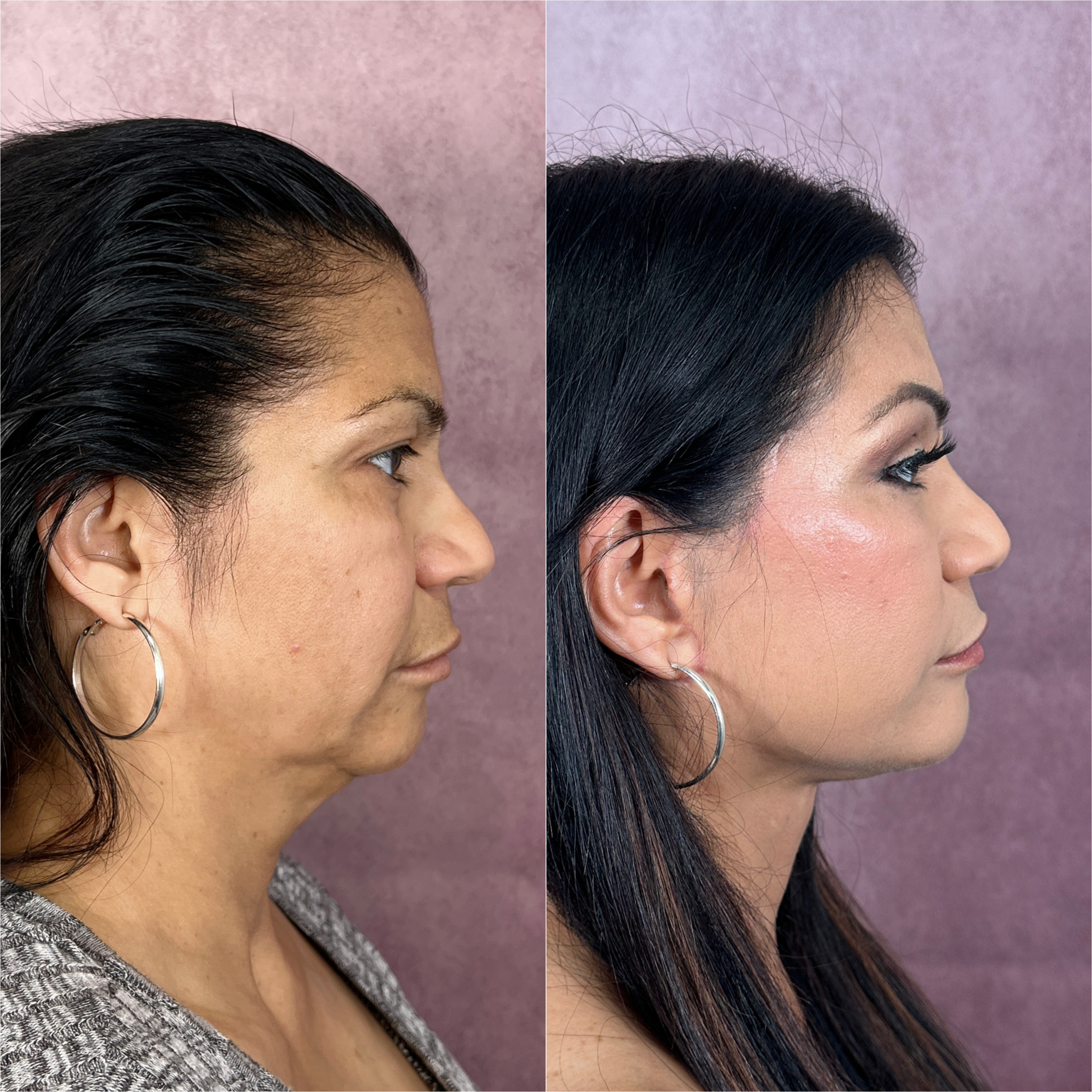 Before and after &mdash; facelift and neck lift, profile view