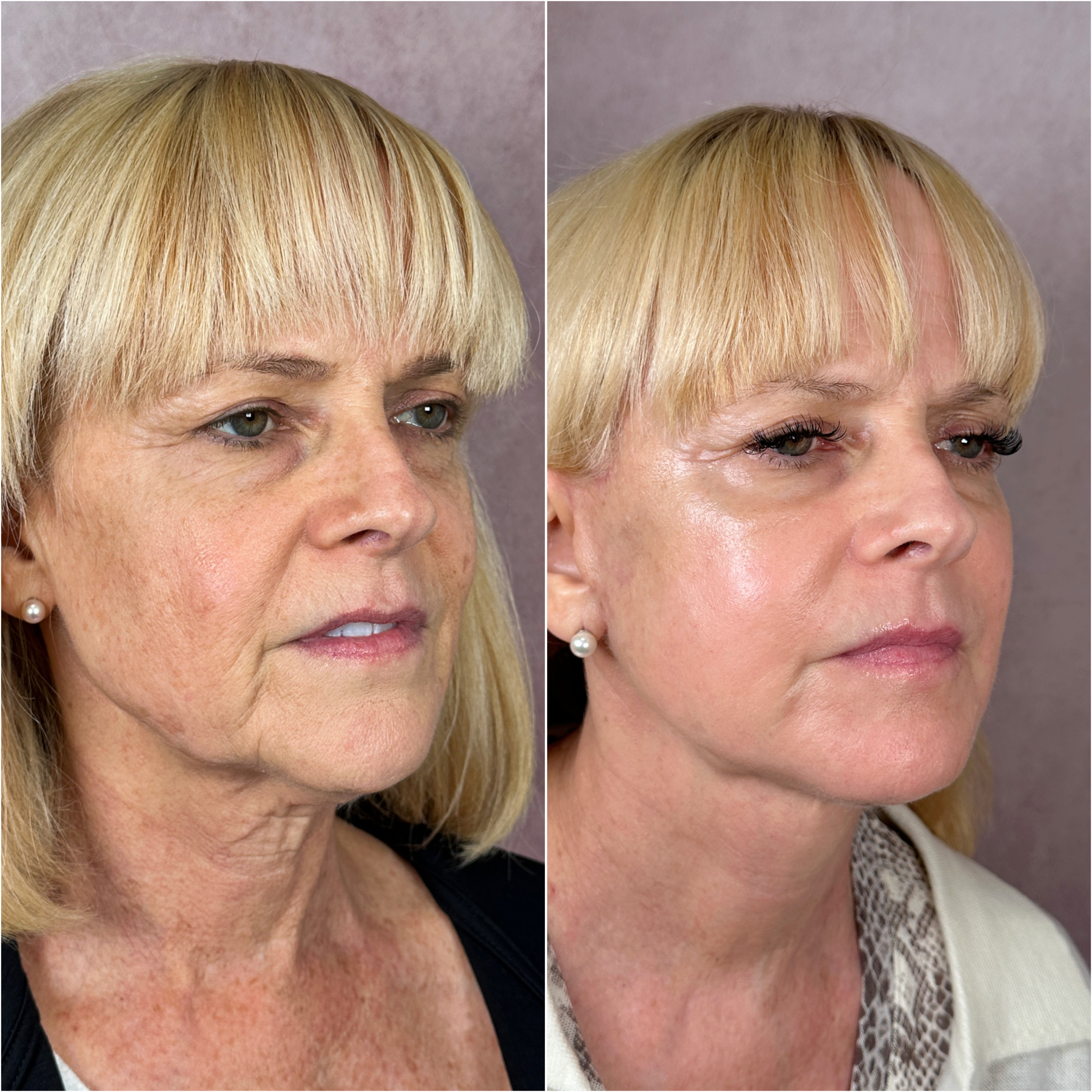 Before and after — deep plane facelift · oblique view