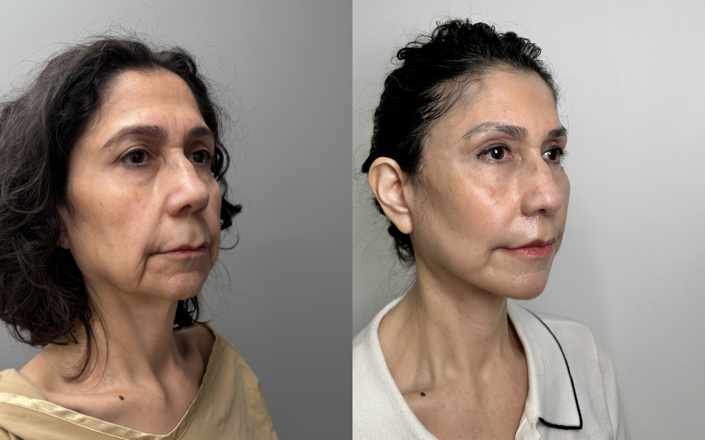 Before and after — deep plane facelift, oblique view