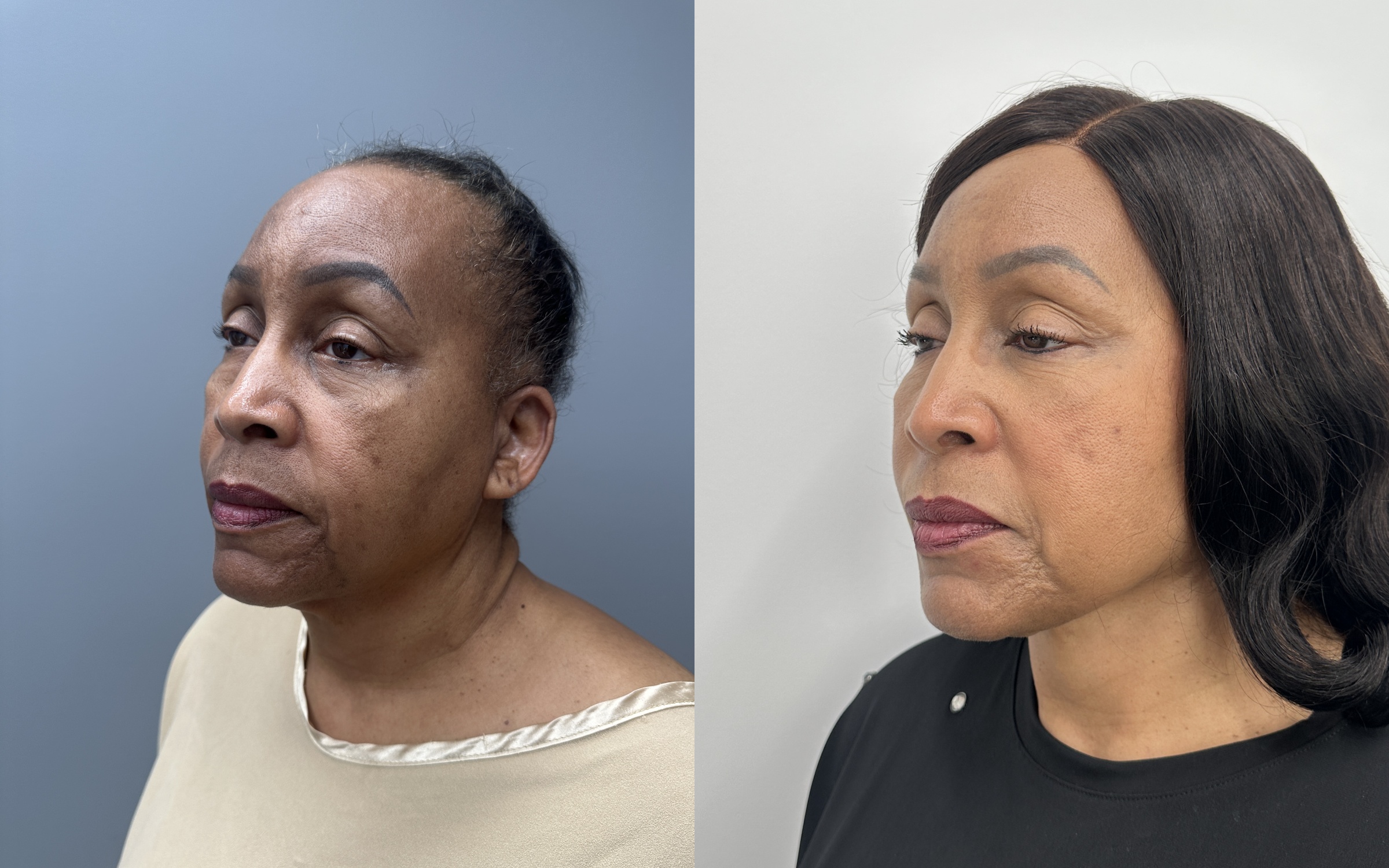 Before and after — deep plane facelift, oblique view