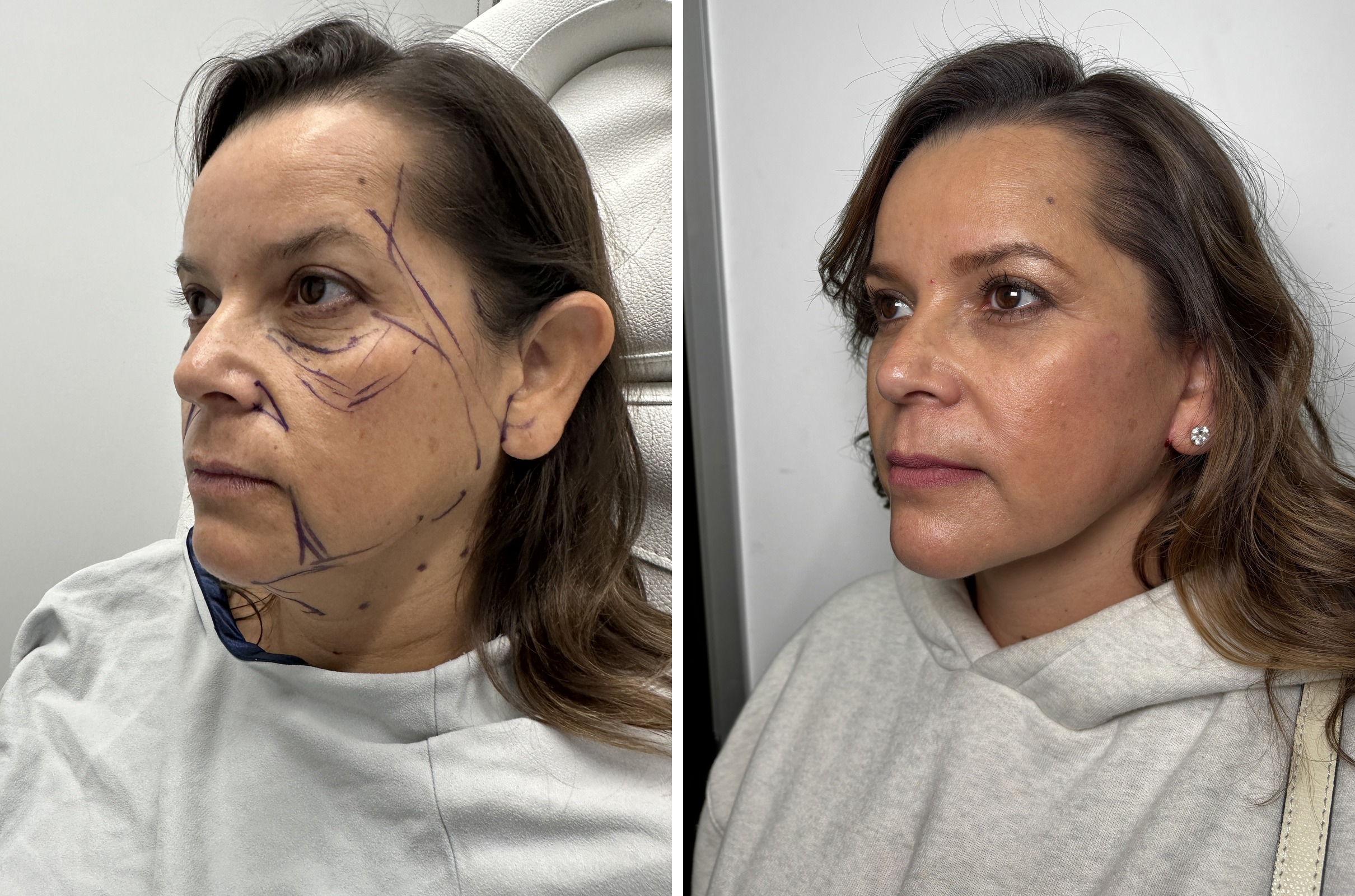 Before and after &mdash; deep plane facelift and neck lift, oblique view