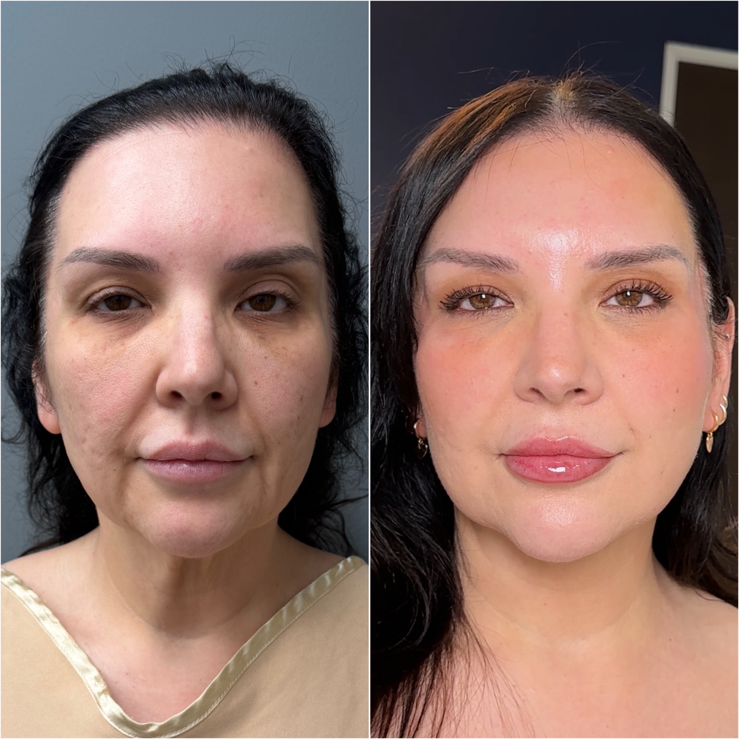 Before and after &mdash; facelift, neck lift, and fat transfer, oblique view
