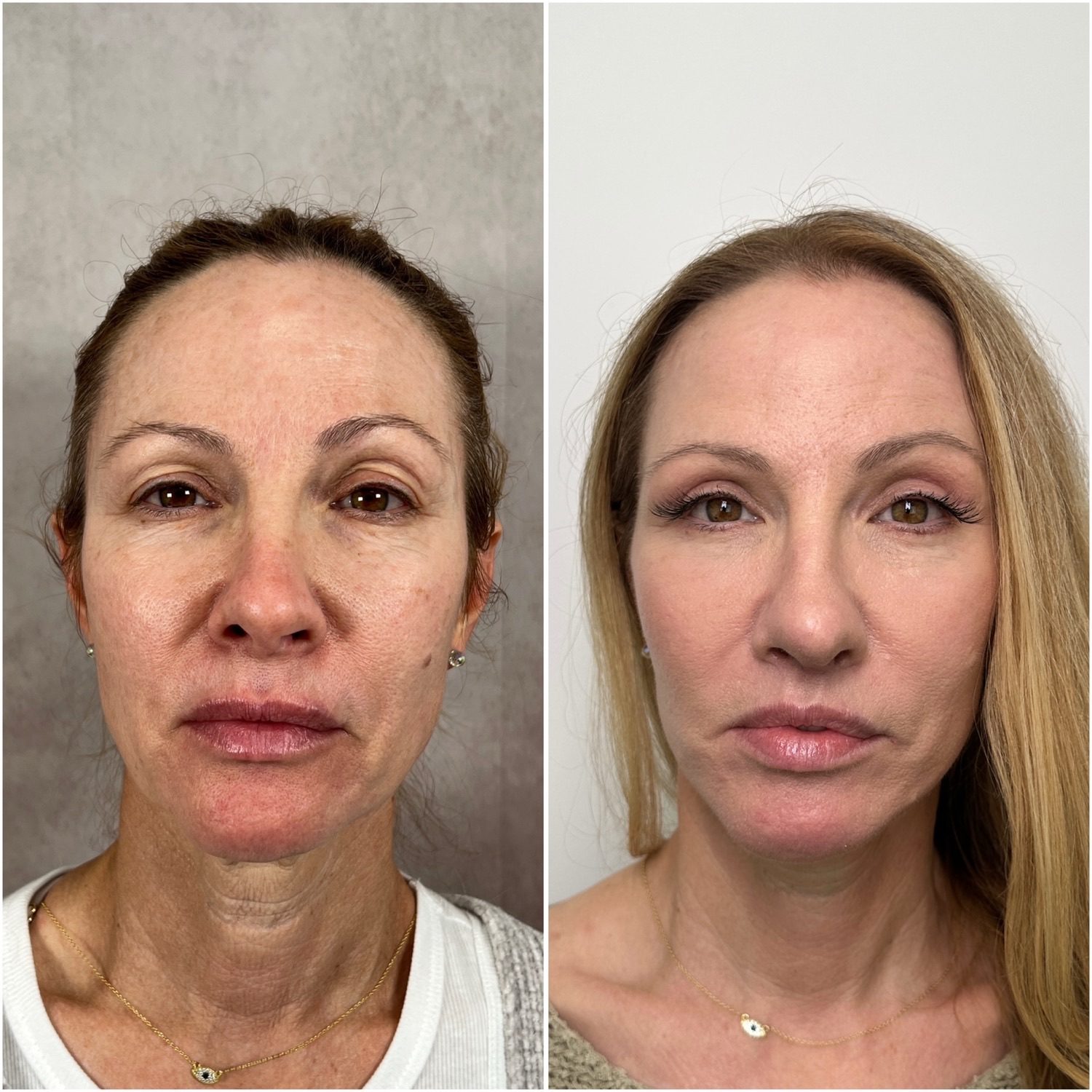 Before and after &mdash; facelift and neck lift as part of The Masterpiece Surgery&trade; with brow lift, upper blepharoplasty, lower lid skin pinch, lip lift, fat transfer, CO2 laser resurfacing and revision rhinoplasty, frontal view
