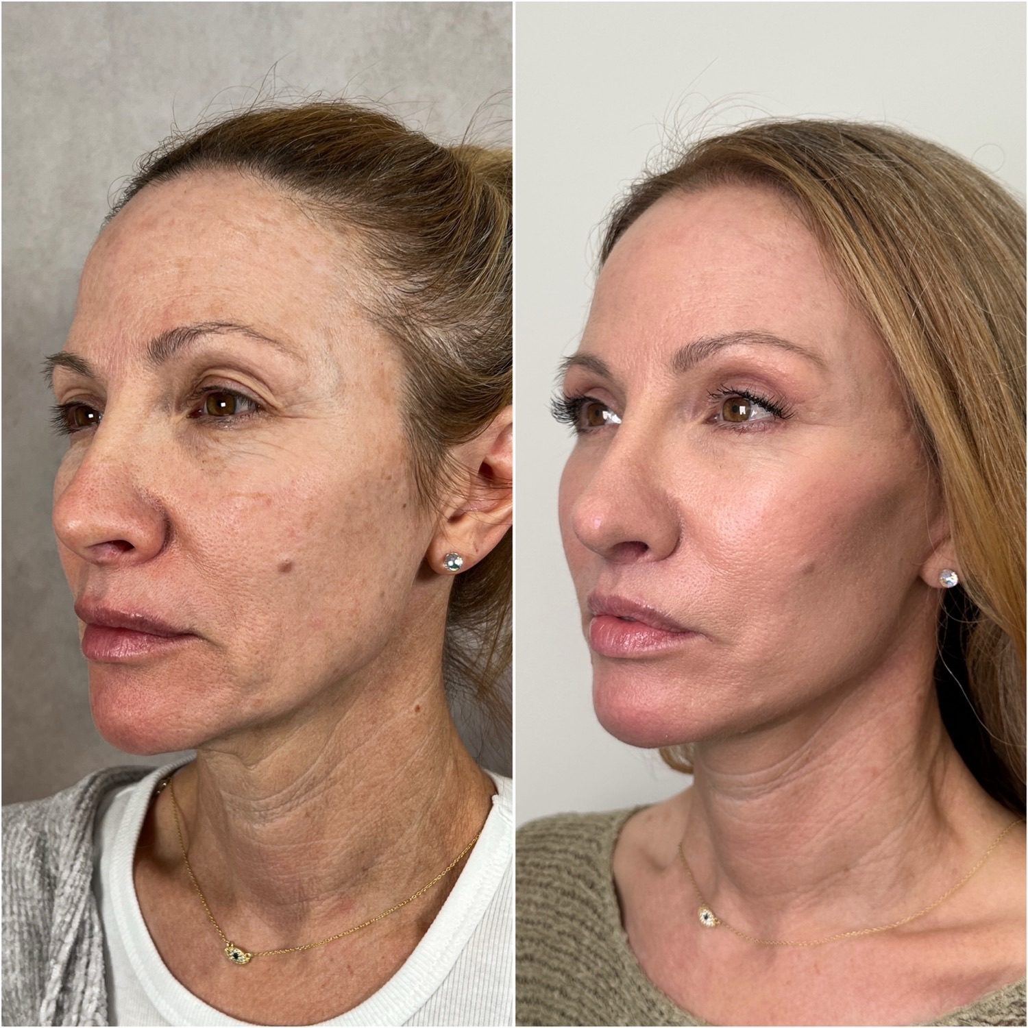 Before and after &mdash; facelift and neck lift as part of The Masterpiece Surgery&trade; with brow lift, upper blepharoplasty, lower lid skin pinch, lip lift, fat transfer, CO2 laser resurfacing and revision rhinoplasty, opposite oblique view