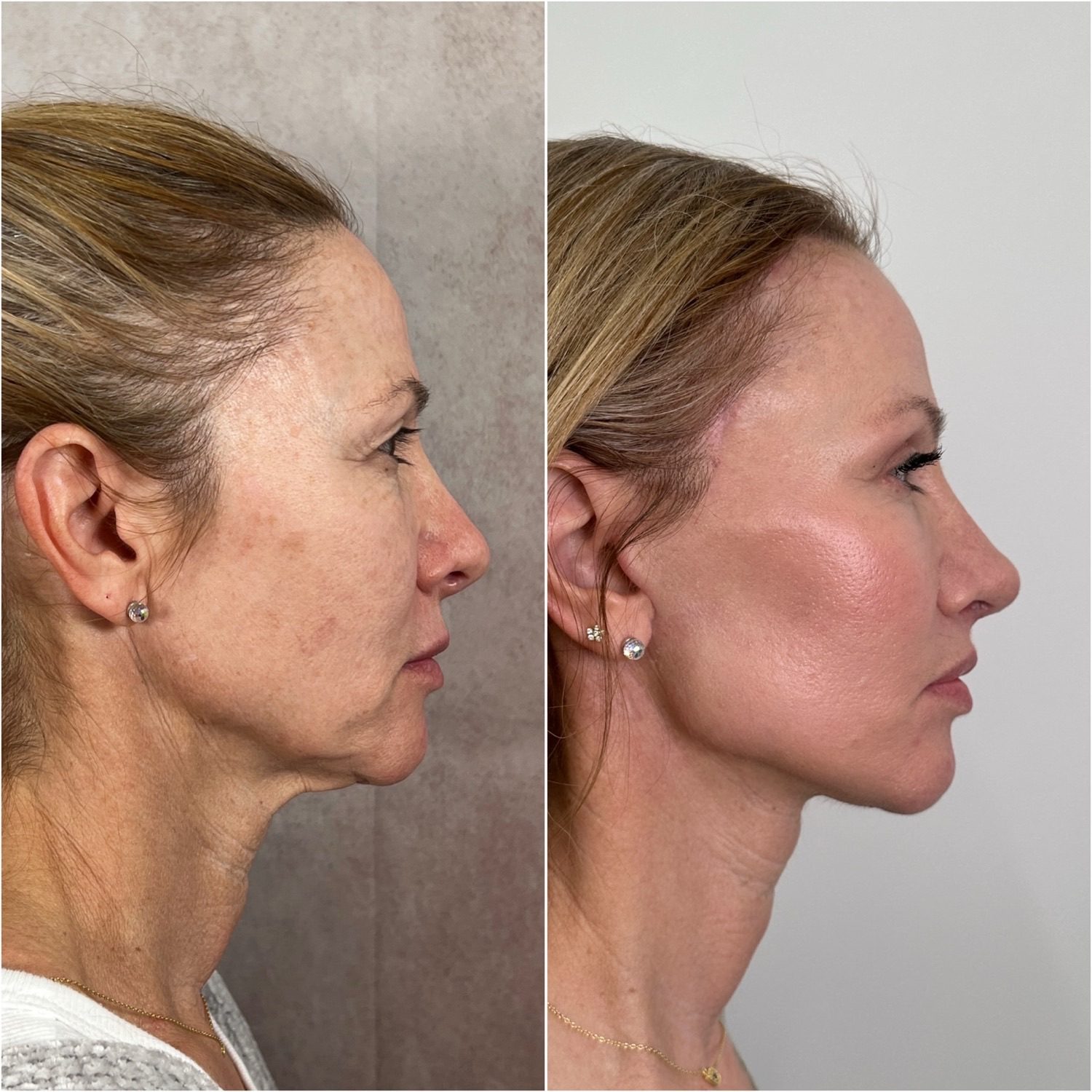 Before and after &mdash; facelift and neck lift as part of The Masterpiece Surgery&trade; with brow lift, upper blepharoplasty, lower lid skin pinch, lip lift, fat transfer, CO2 laser resurfacing and revision rhinoplasty, profile view