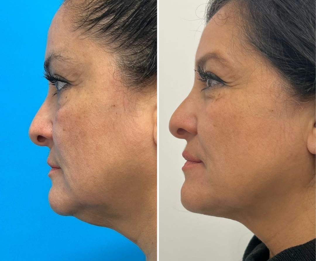 FaceTite/AccuTite to eyes, nasolabial, and jowls with neck liposuction and platysmaplasty before and after · before and after composite
