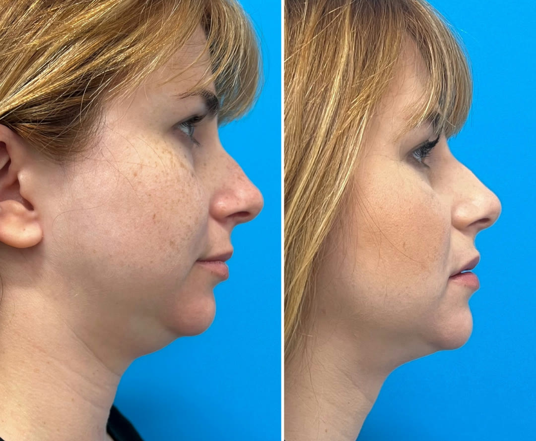 Neck liposuction with FaceTite before and after · before and after composite