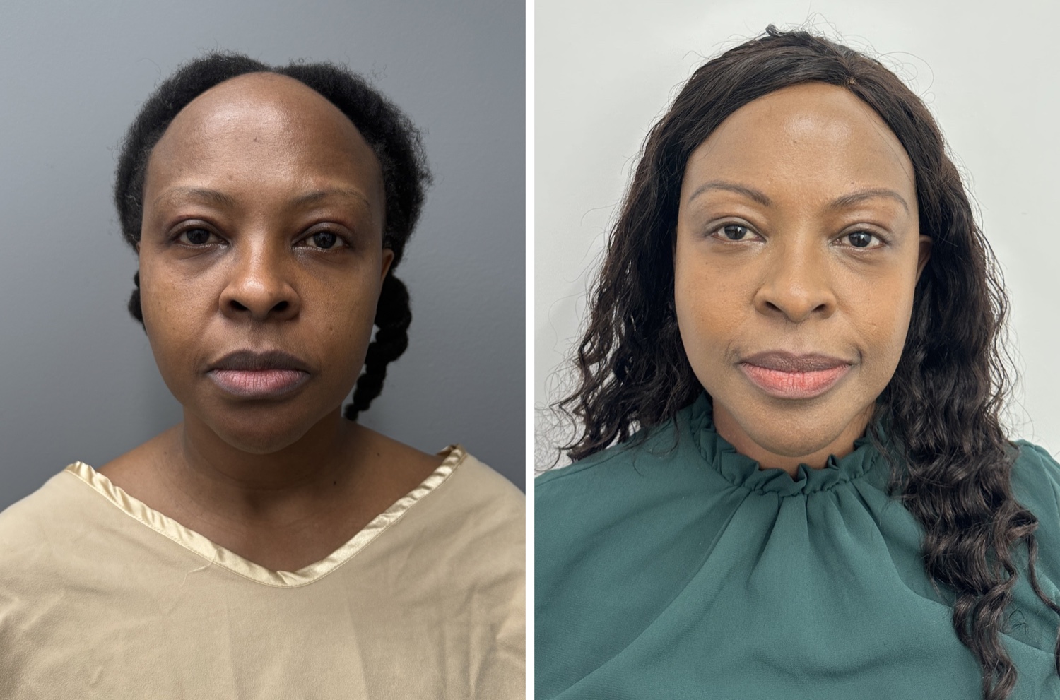 Fat Transfer + Face and Neck Lift &mdash; featured patient