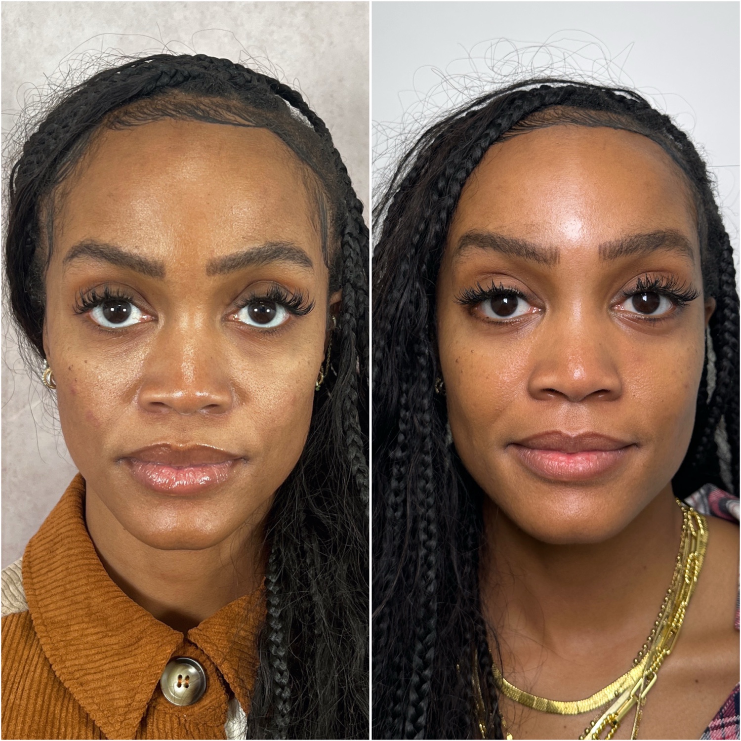Fat Transfer before and after · before and after composite