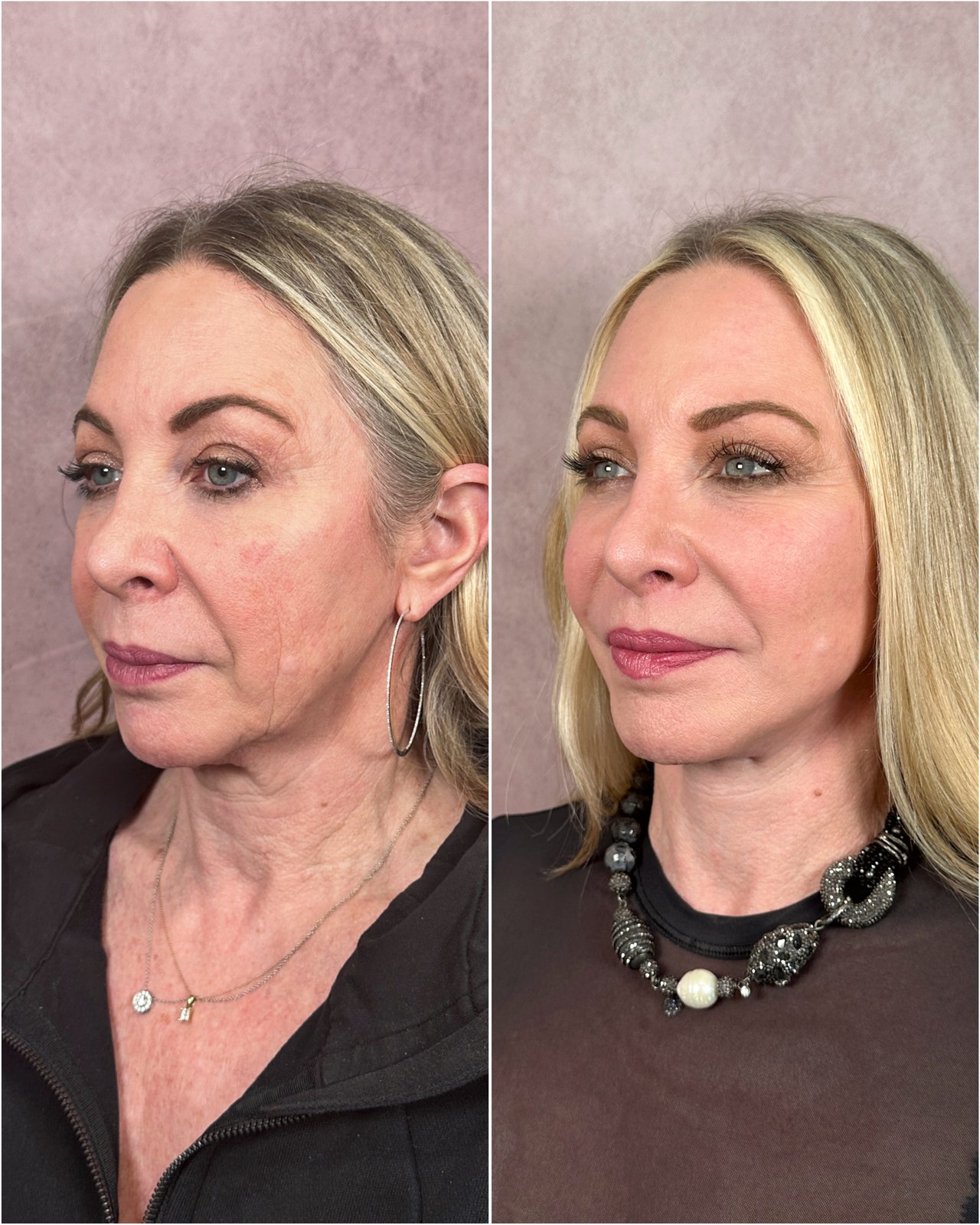 The Masterpiece Surgery featured patient &mdash; before and after · before and after composite