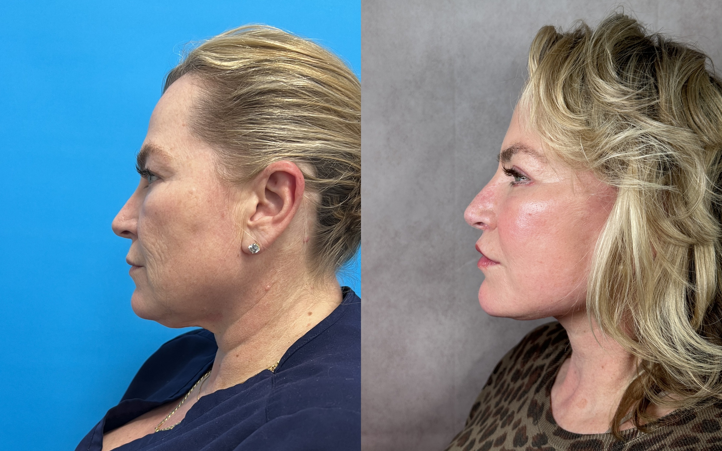 Before and after &mdash; The Masterpiece Surgery&trade;, profile view