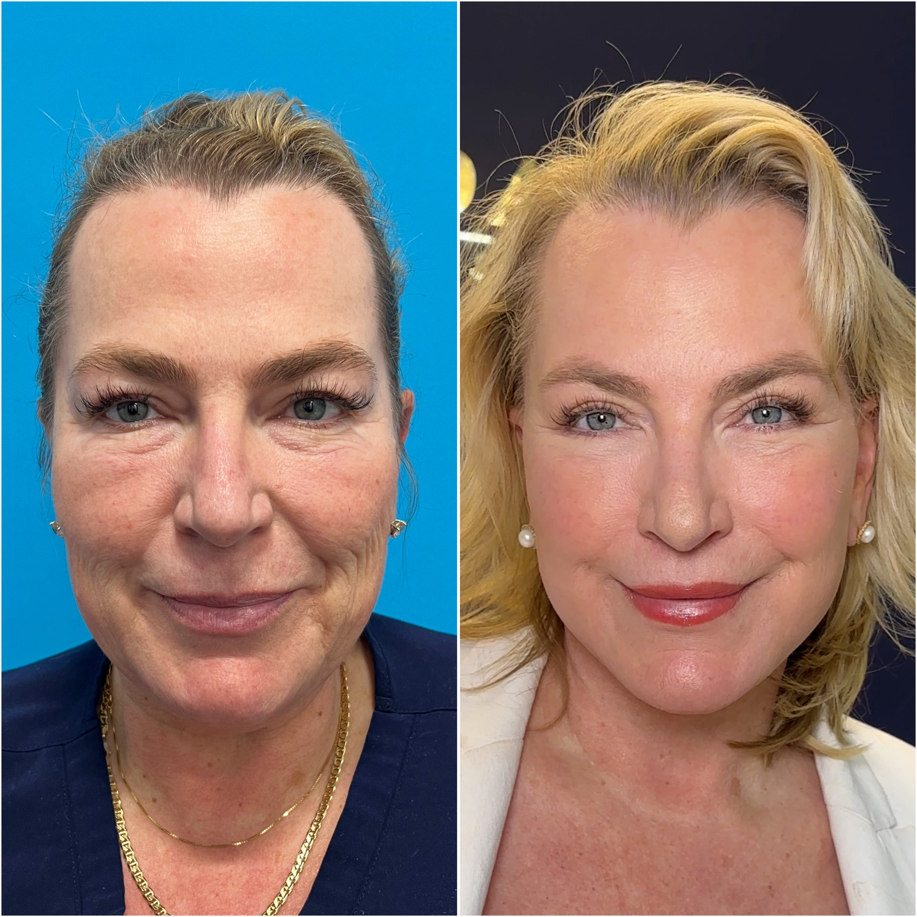 The Masterpiece Surgery&trade; patient &mdash; before and after · before and after composite