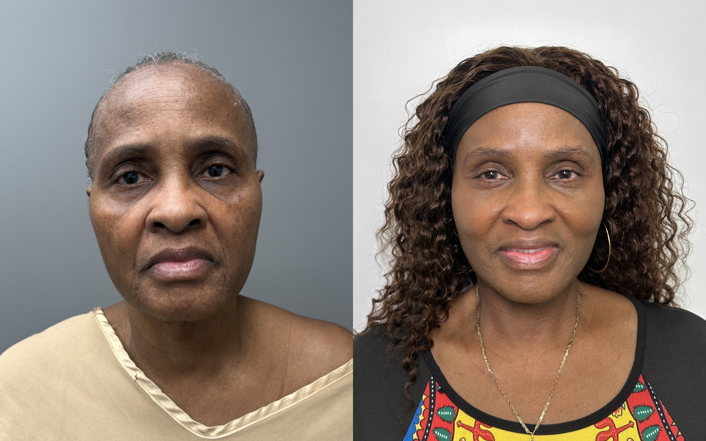Before and after — The Masterpiece Surgery&trade;, frontal view