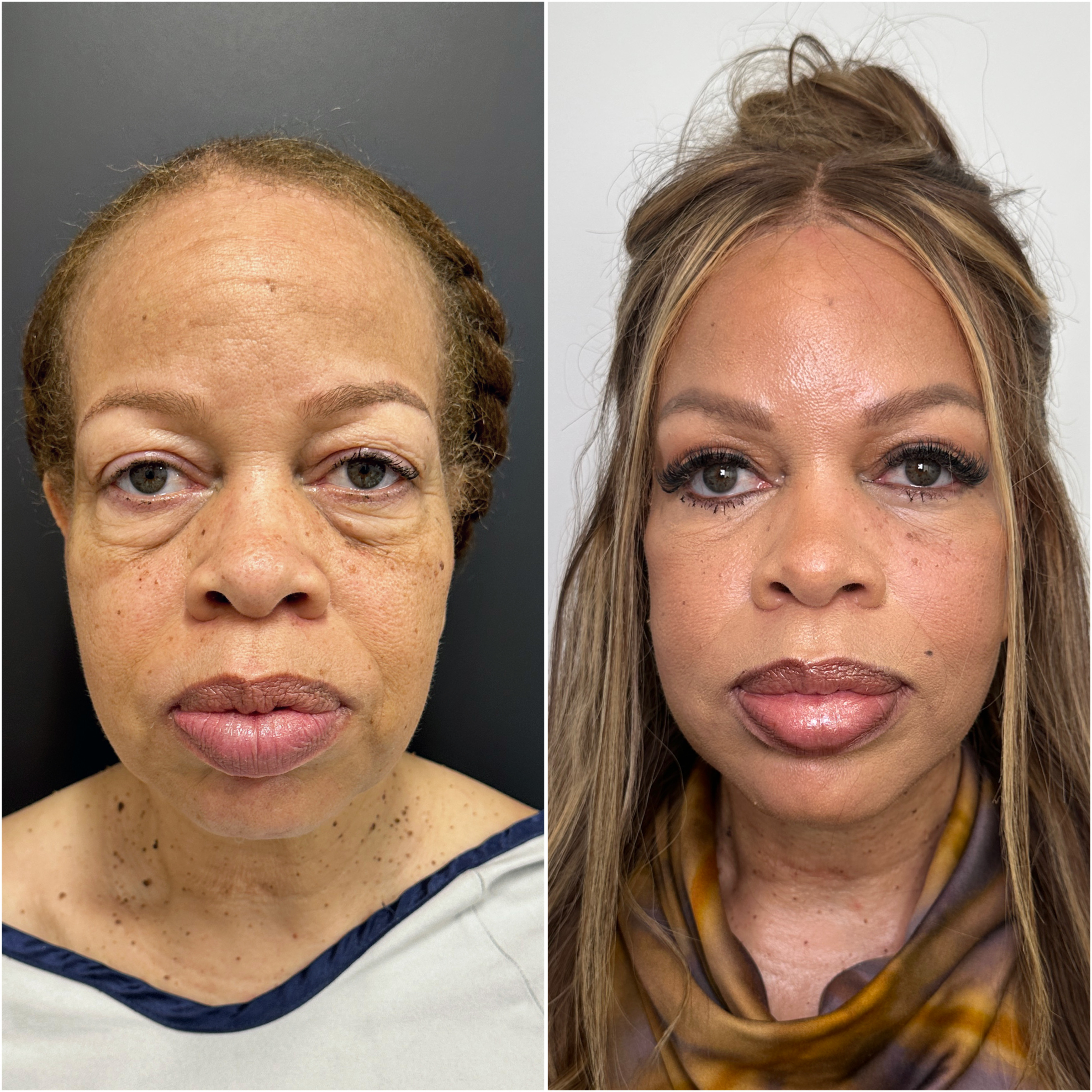 The Masterpiece Surgery&trade; patient &mdash; before and after · before and after composite