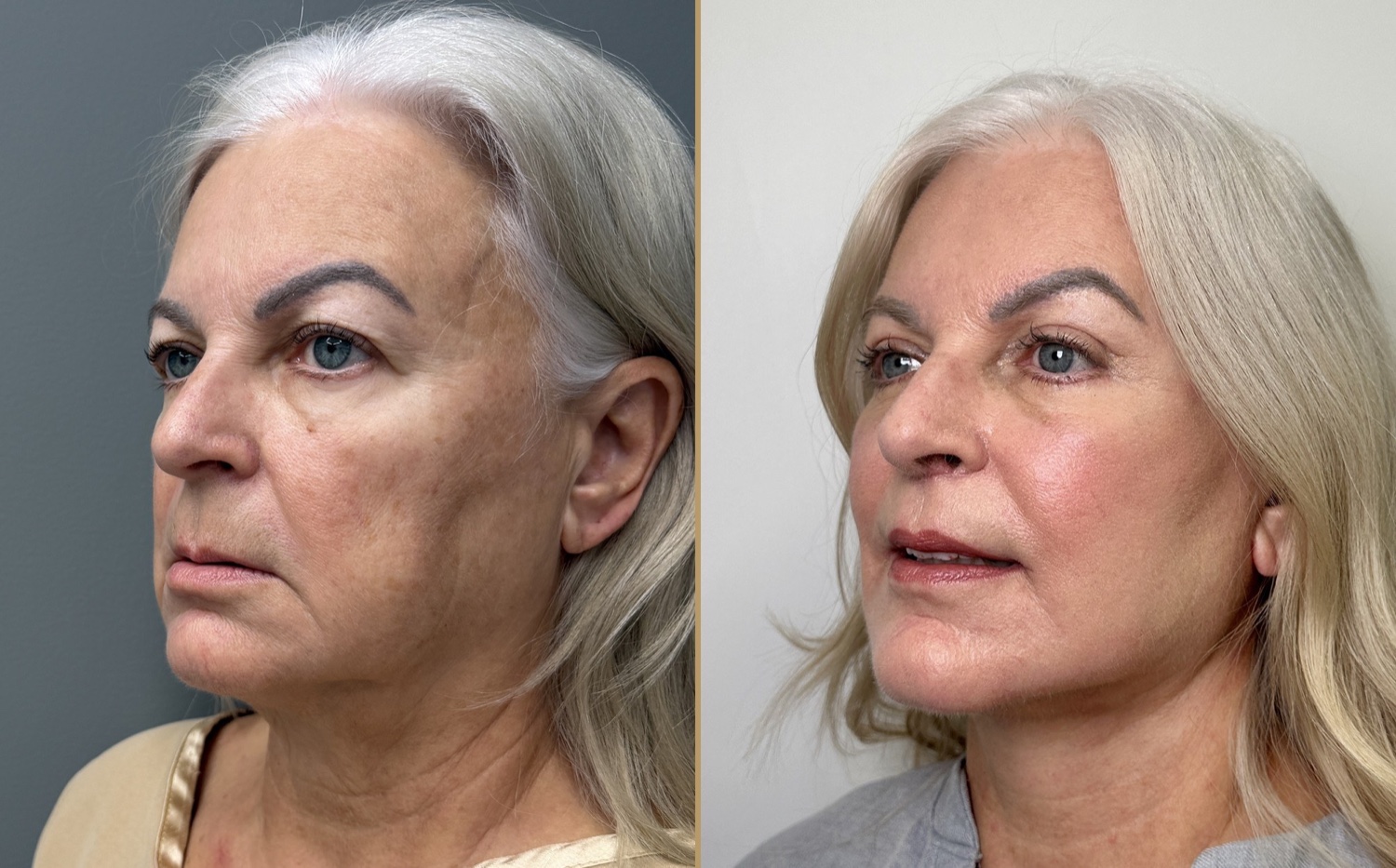 Before and after &mdash; The Masterpiece Surgery&trade;, left, oblique view