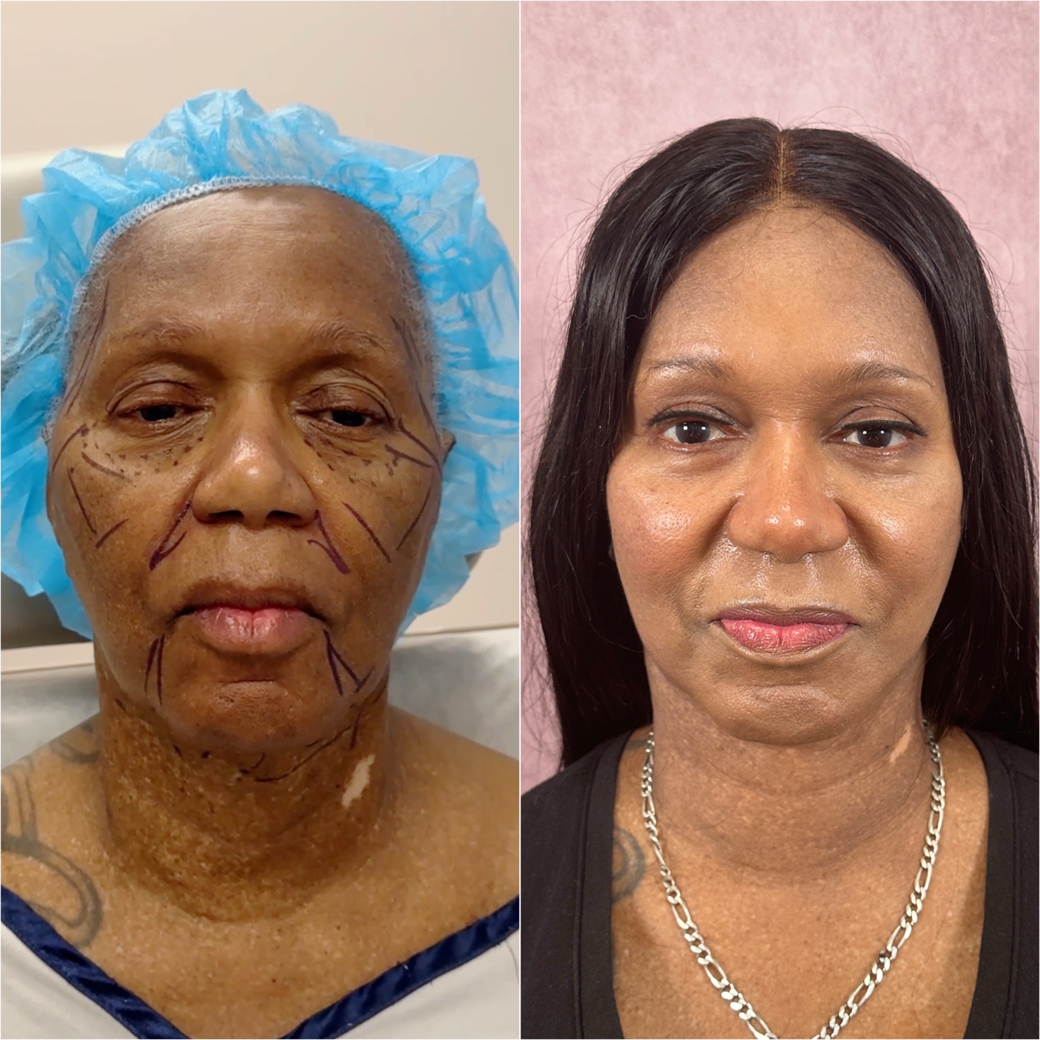 Before and after &mdash; The Masterpiece Surgery&trade;, frontal view