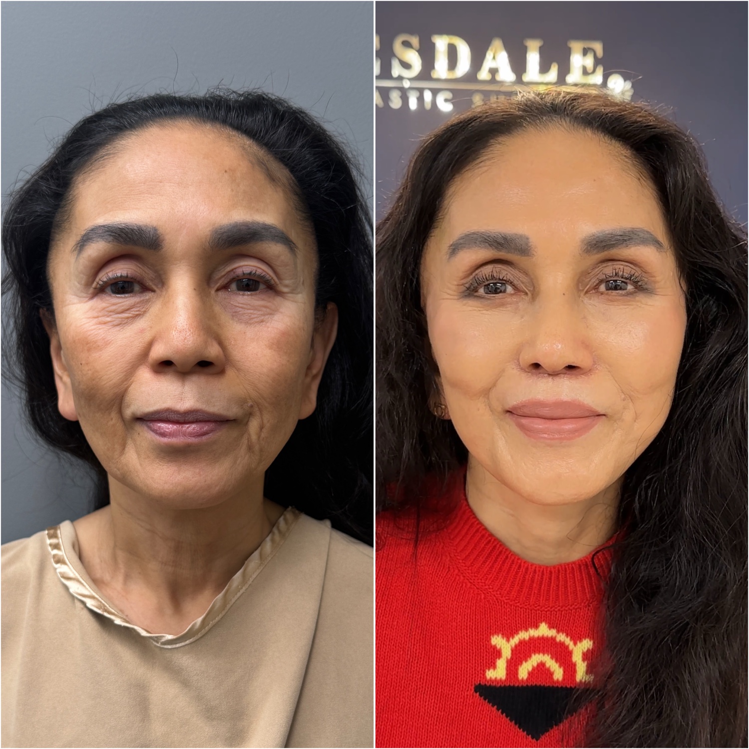Before and after &mdash; The Masterpiece Surgery&trade;, frontal view