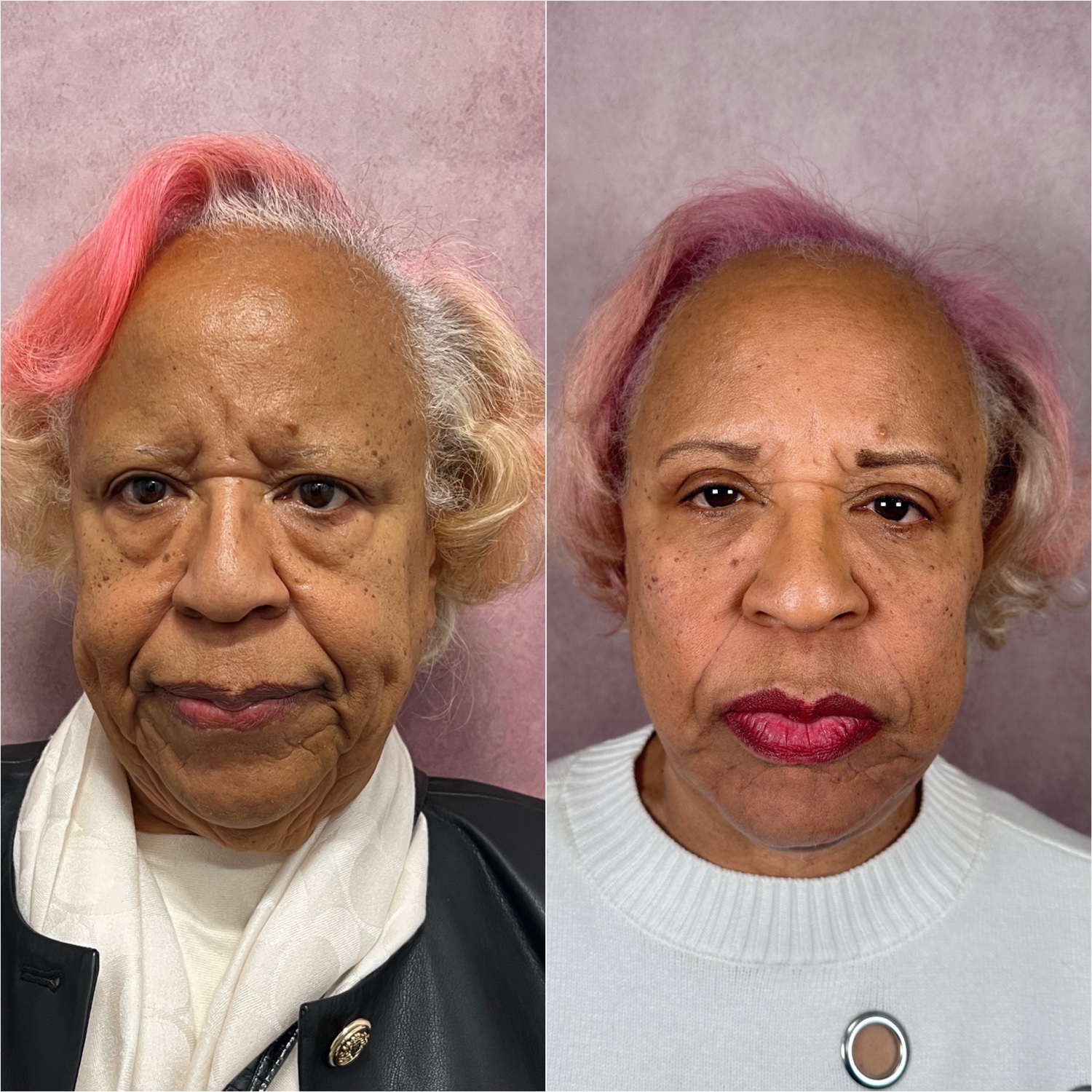 Before and after &mdash; The Masterpiece Surgery&trade;, frontal view