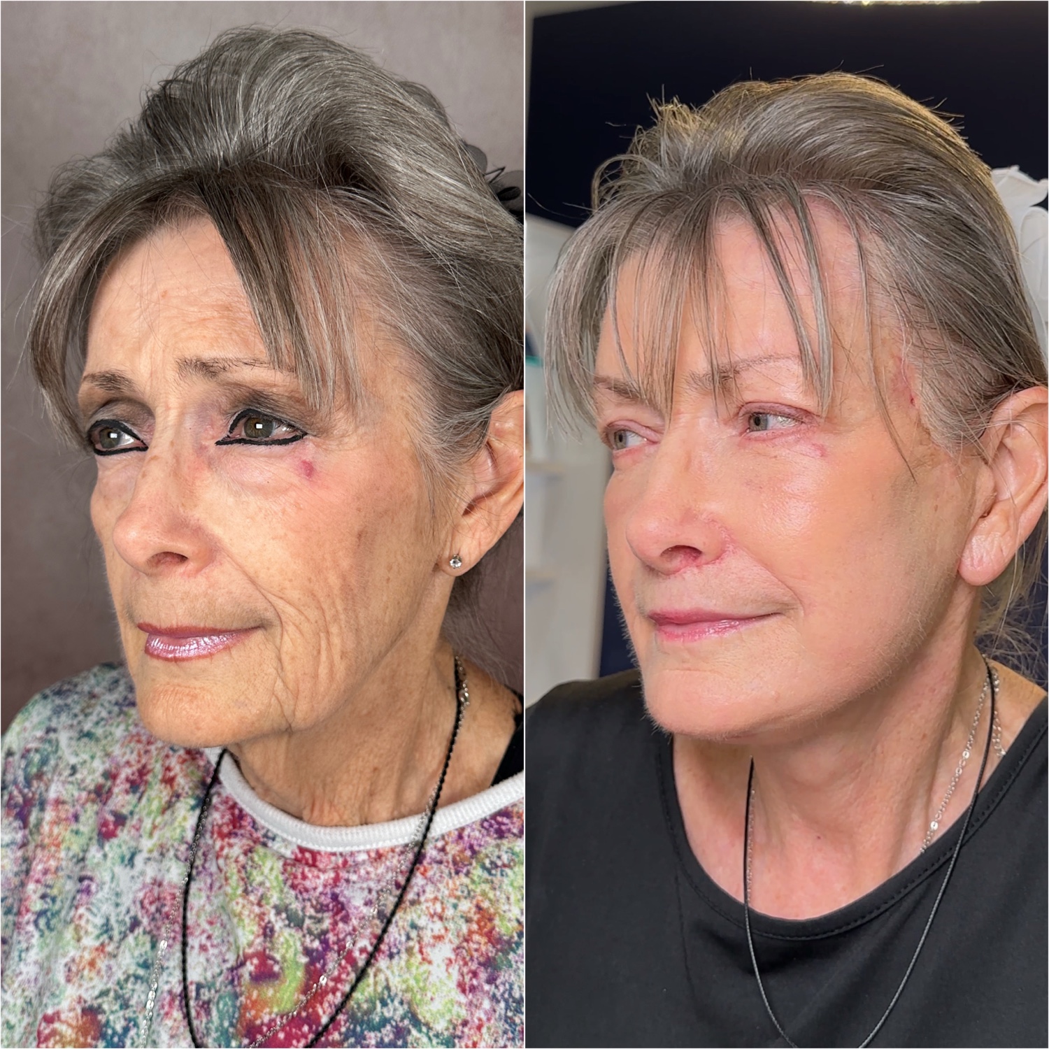 Before and after &mdash; The Masterpiece Surgery&trade;, oblique view