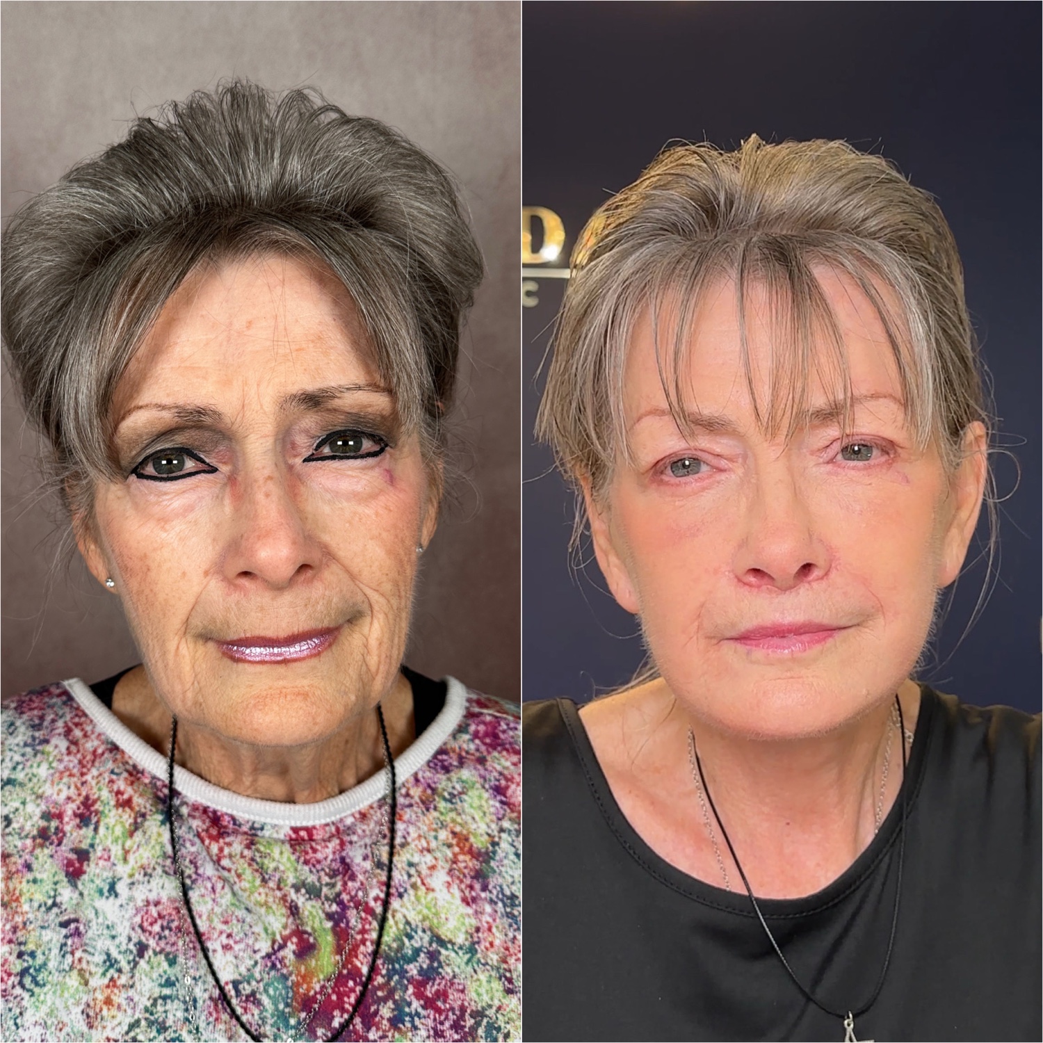 Before and after &mdash; The Masterpiece Surgery&trade;, frontal view