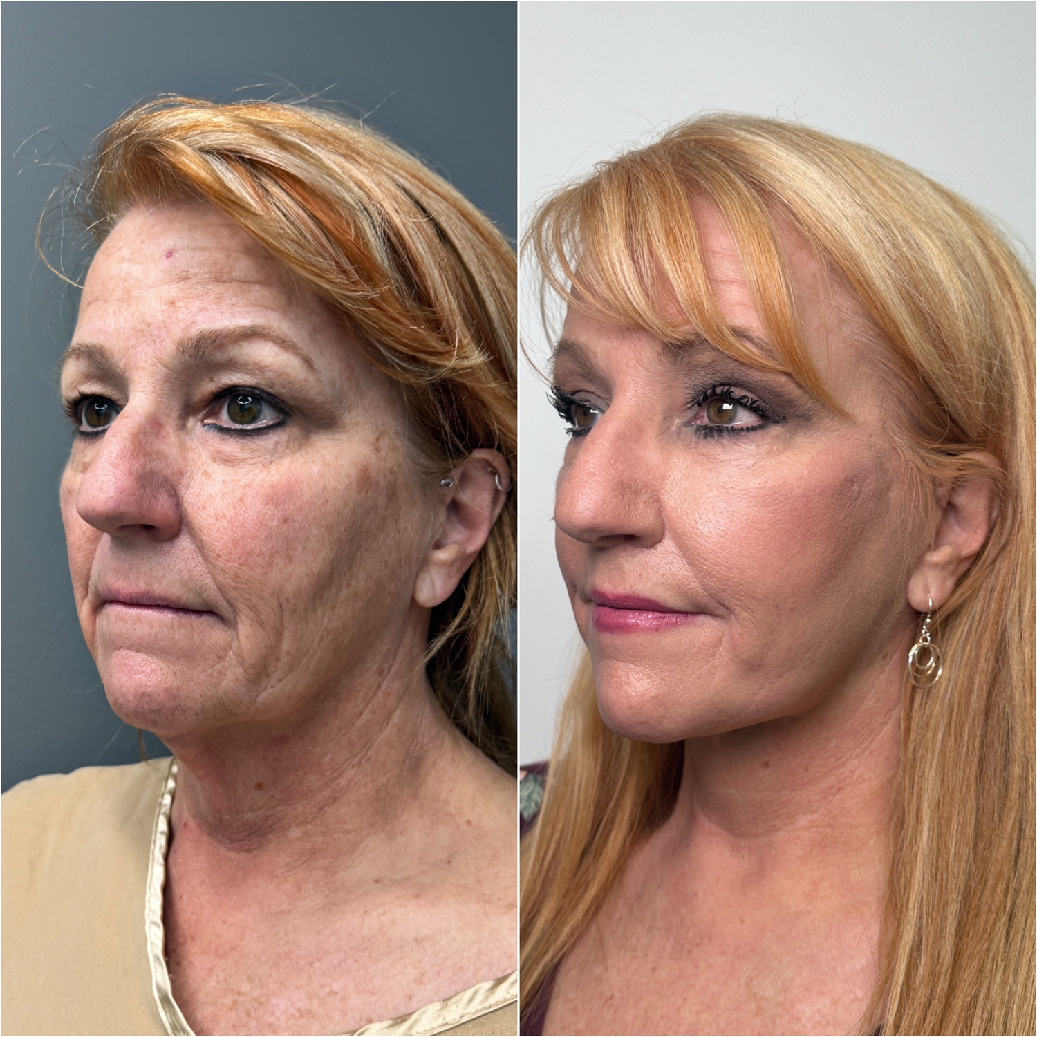 Before and after &mdash; The Masterpiece Surgery&trade;, oblique view