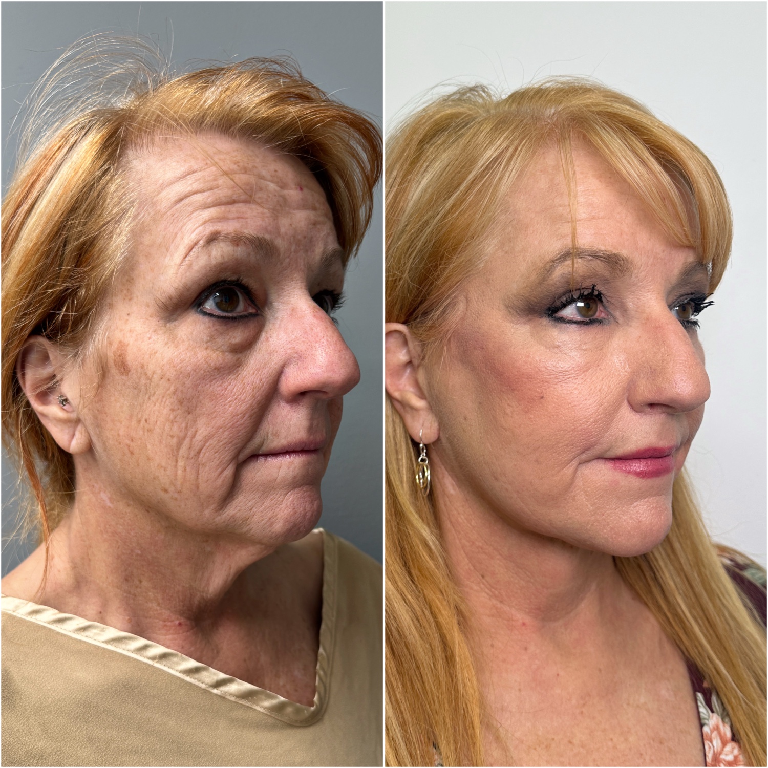 Before and after &mdash; The Masterpiece Surgery&trade;, oblique view