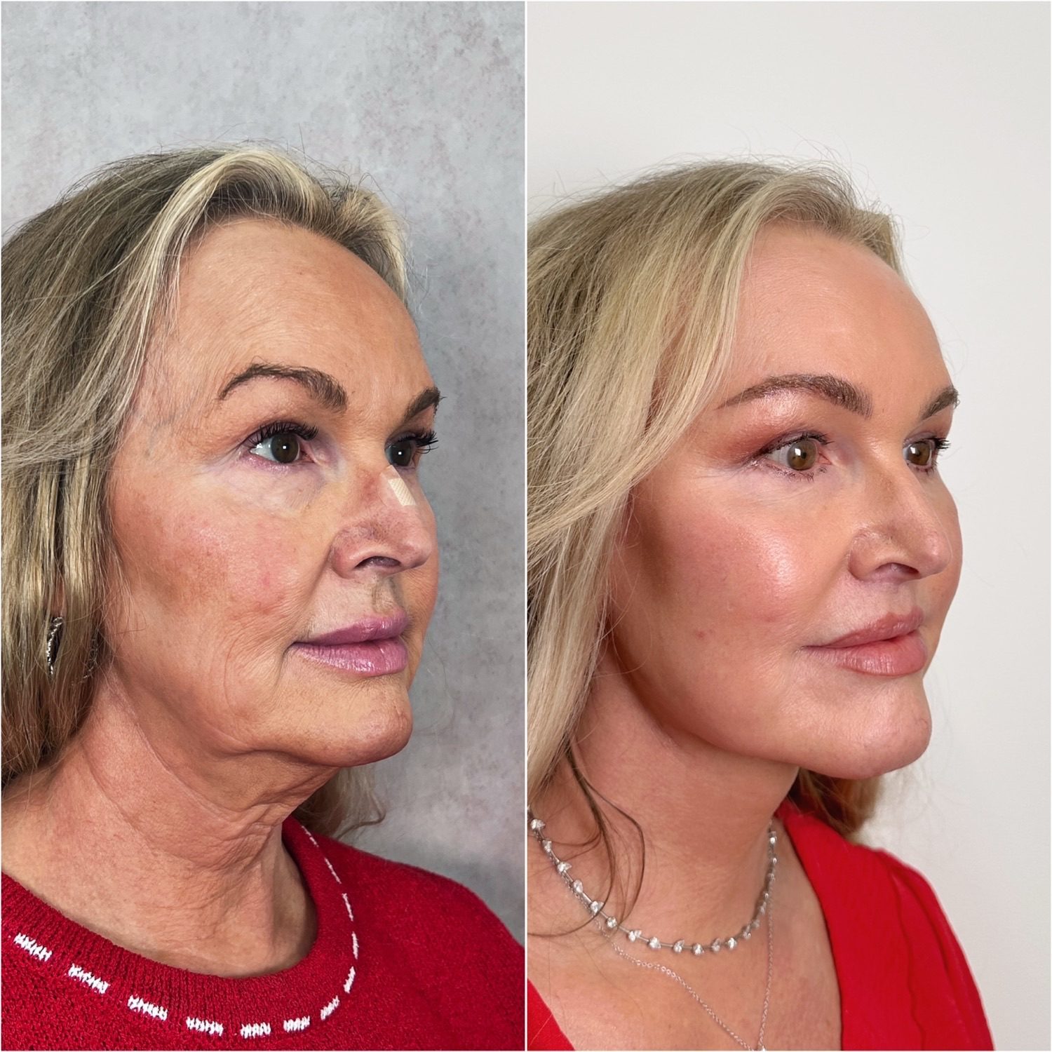 Before and after &mdash; The Masterpiece Surgery&trade;: deep plane facelift, deep neck lift, brow lift, upper blepharoplasty, lower lid skin pinch, lip lift, fat transfer and CO2 laser resurfacing, oblique view