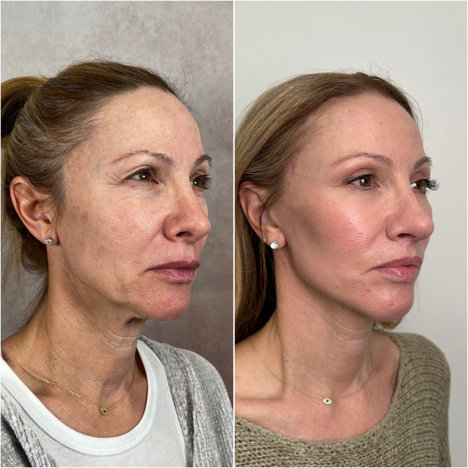 Before and after &mdash; The Masterpiece Surgery&trade;, alternate profile view