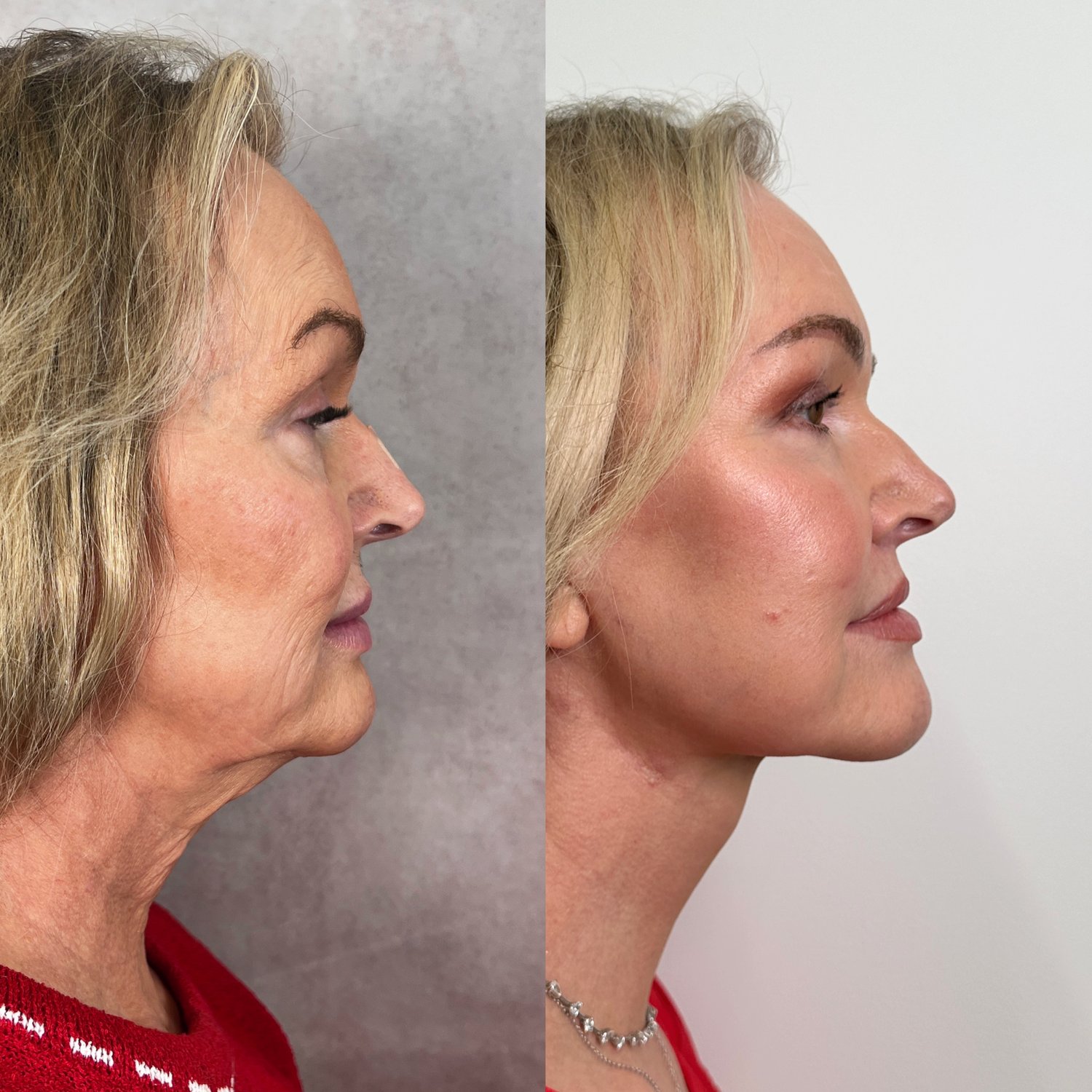 Deep Plane Facelift & Neck Lift before and after · profile view